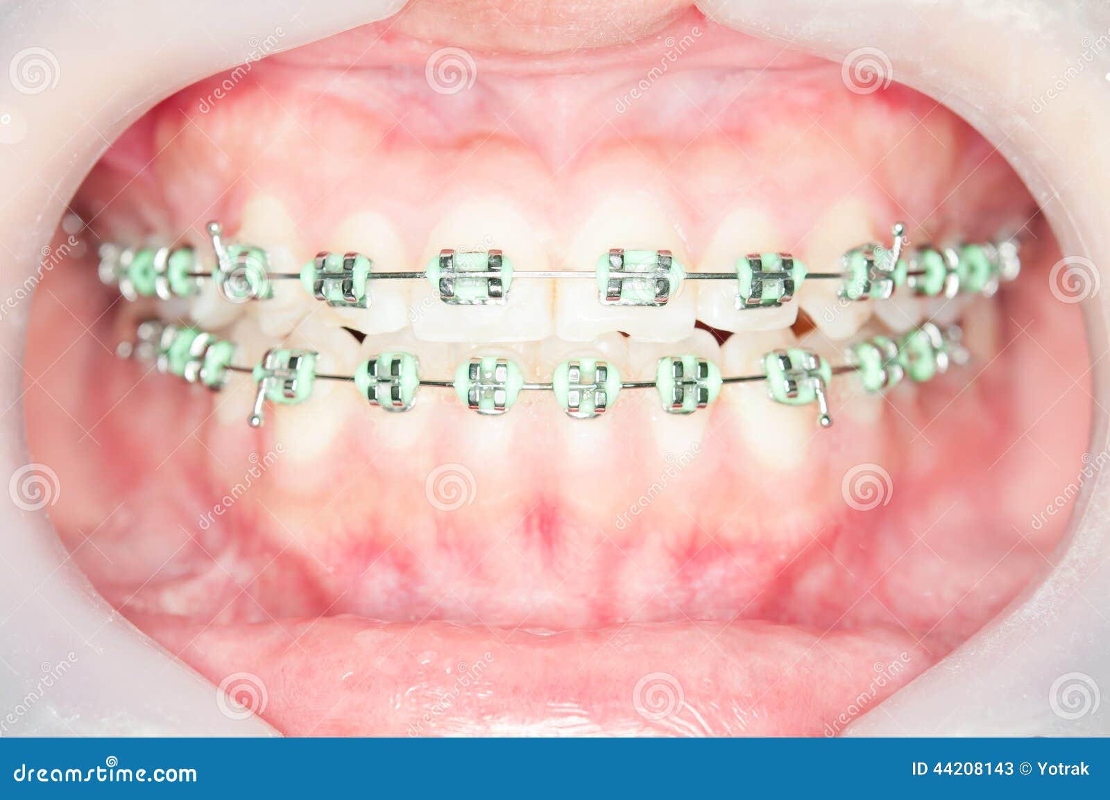 Orthodontic Braces with Oring Stock Image Image of dentistry, braces