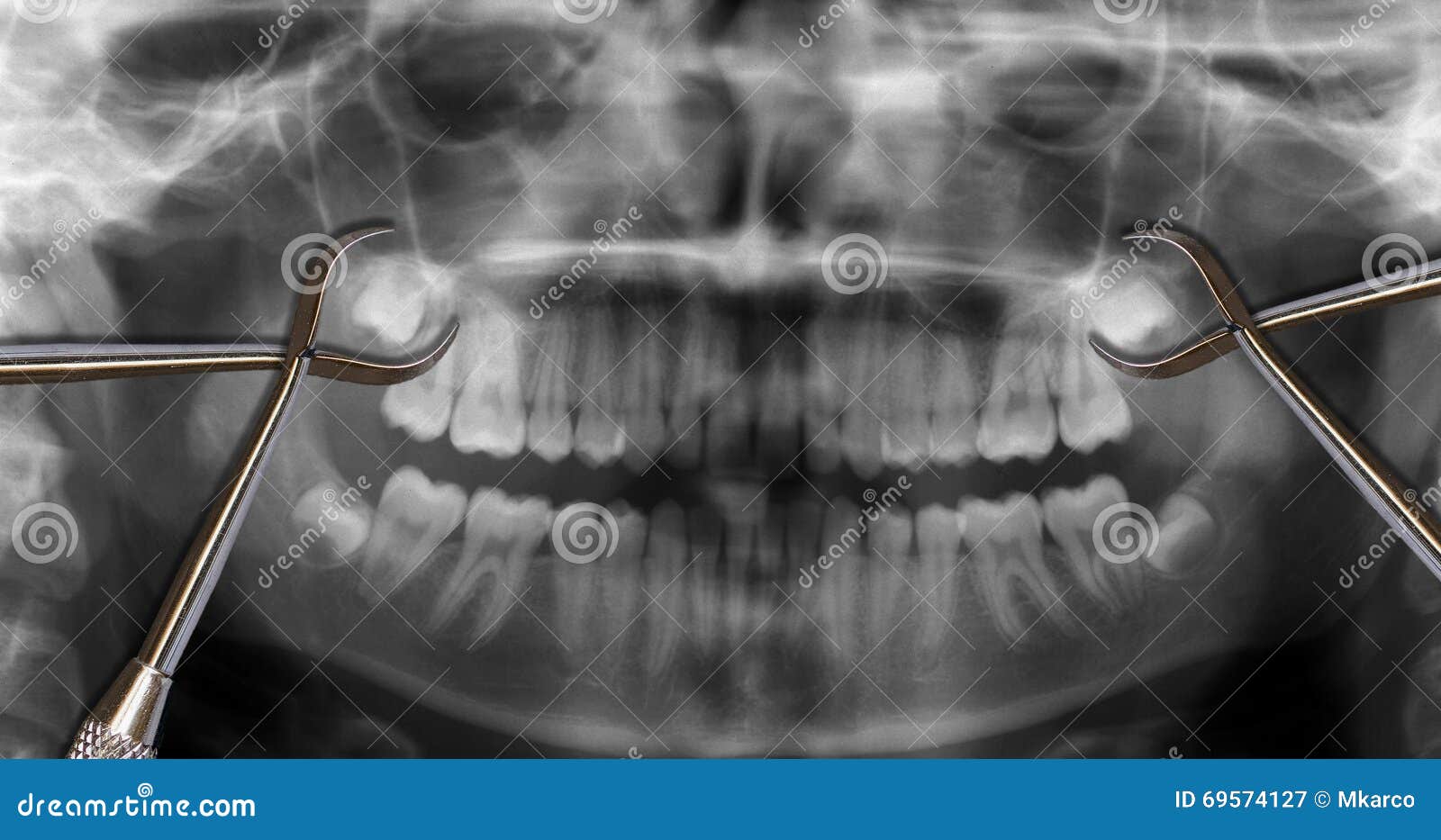 Orthodontic Tools And Wisdom Teeth RoyaltyFree Stock Photography