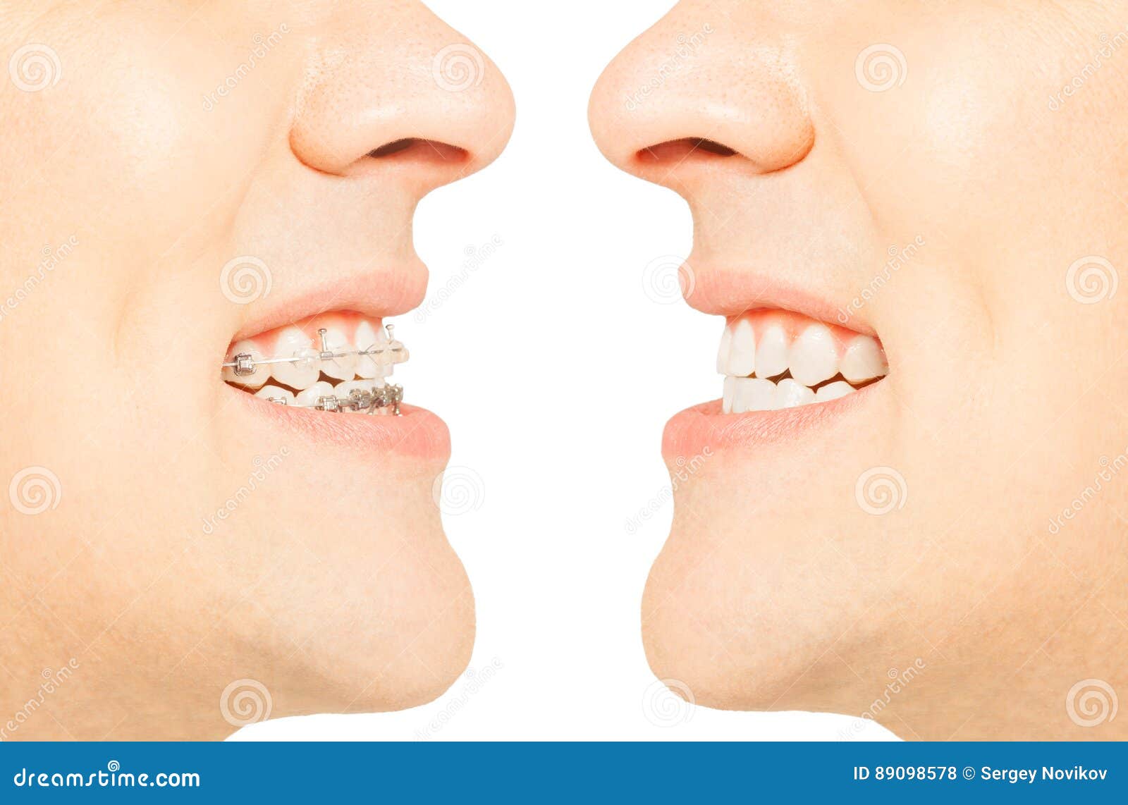before and after orthodontic treatment with braces