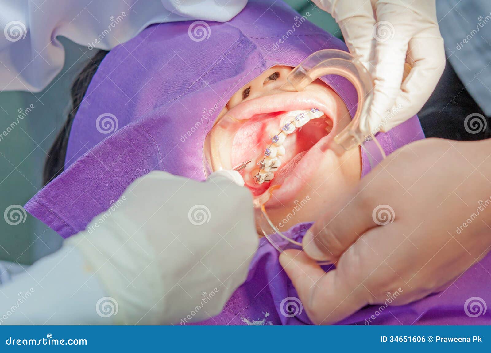 Orthodontics Procedure with Miniscrew. Stock Photo Image of