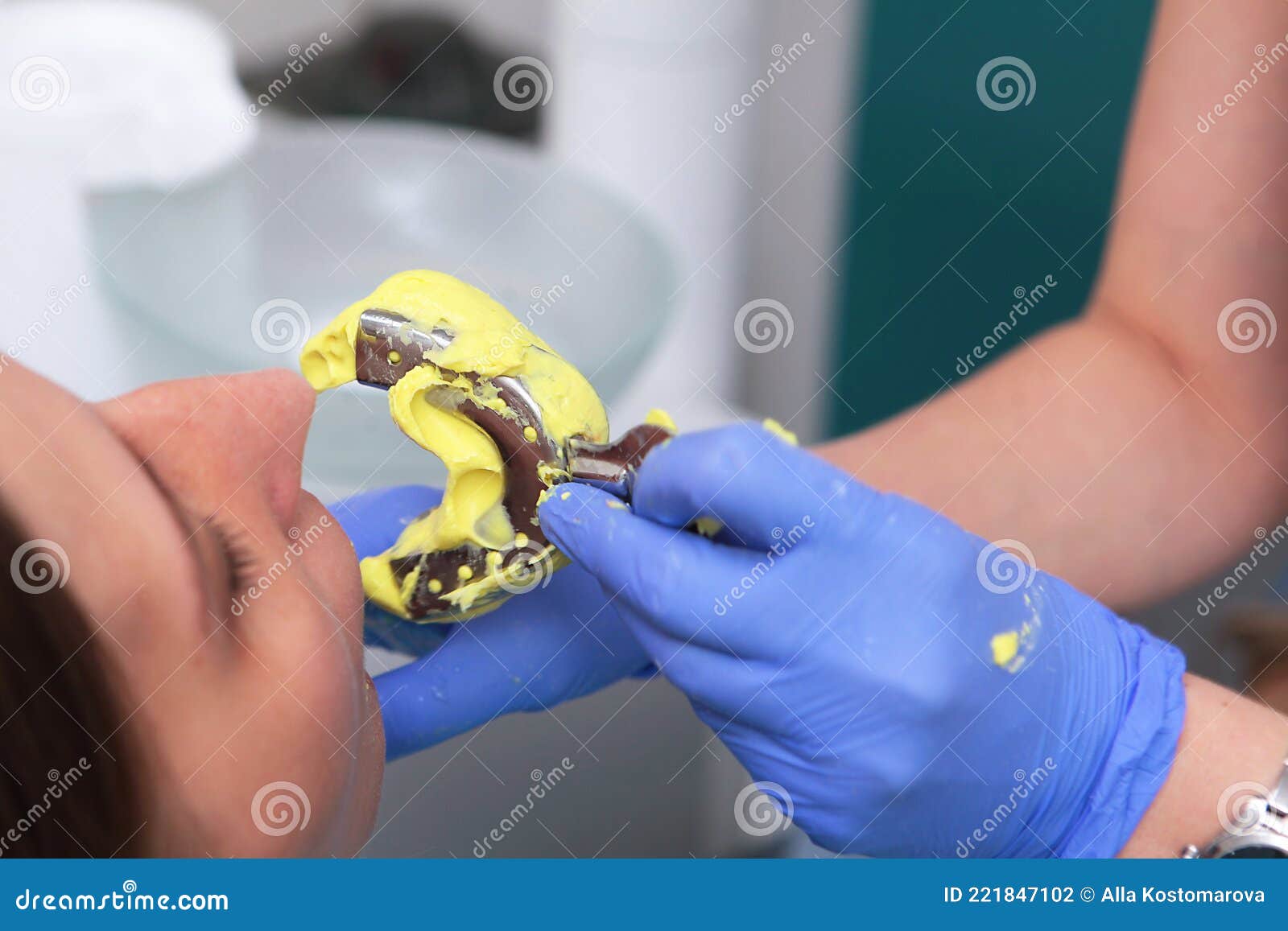 The Orthodontist Makes a Cast of the Patient& X27;s Teeth.Bite