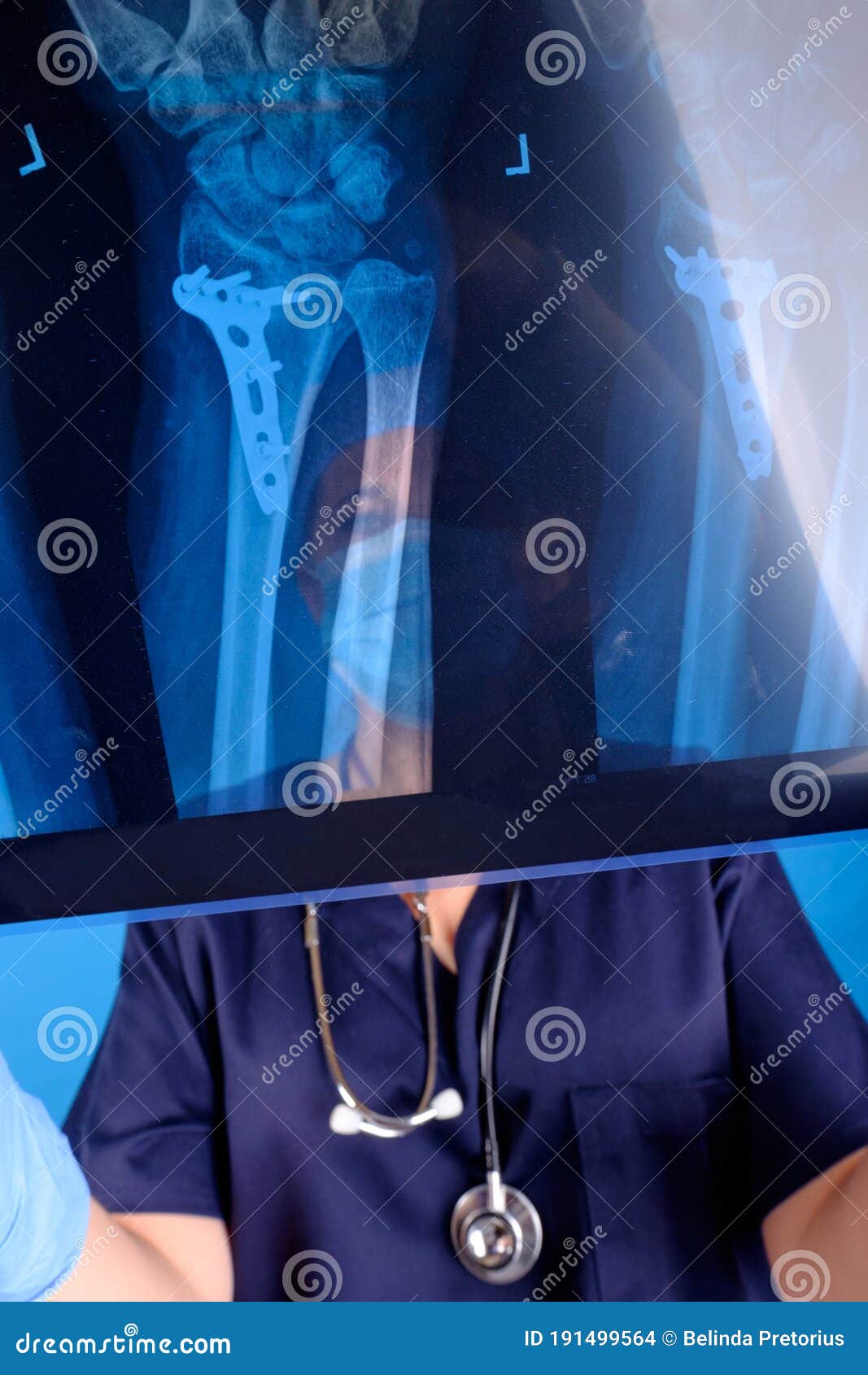 Orthopaedic Surgeon Looking at XRays with Steel Plate in Wrist Stock