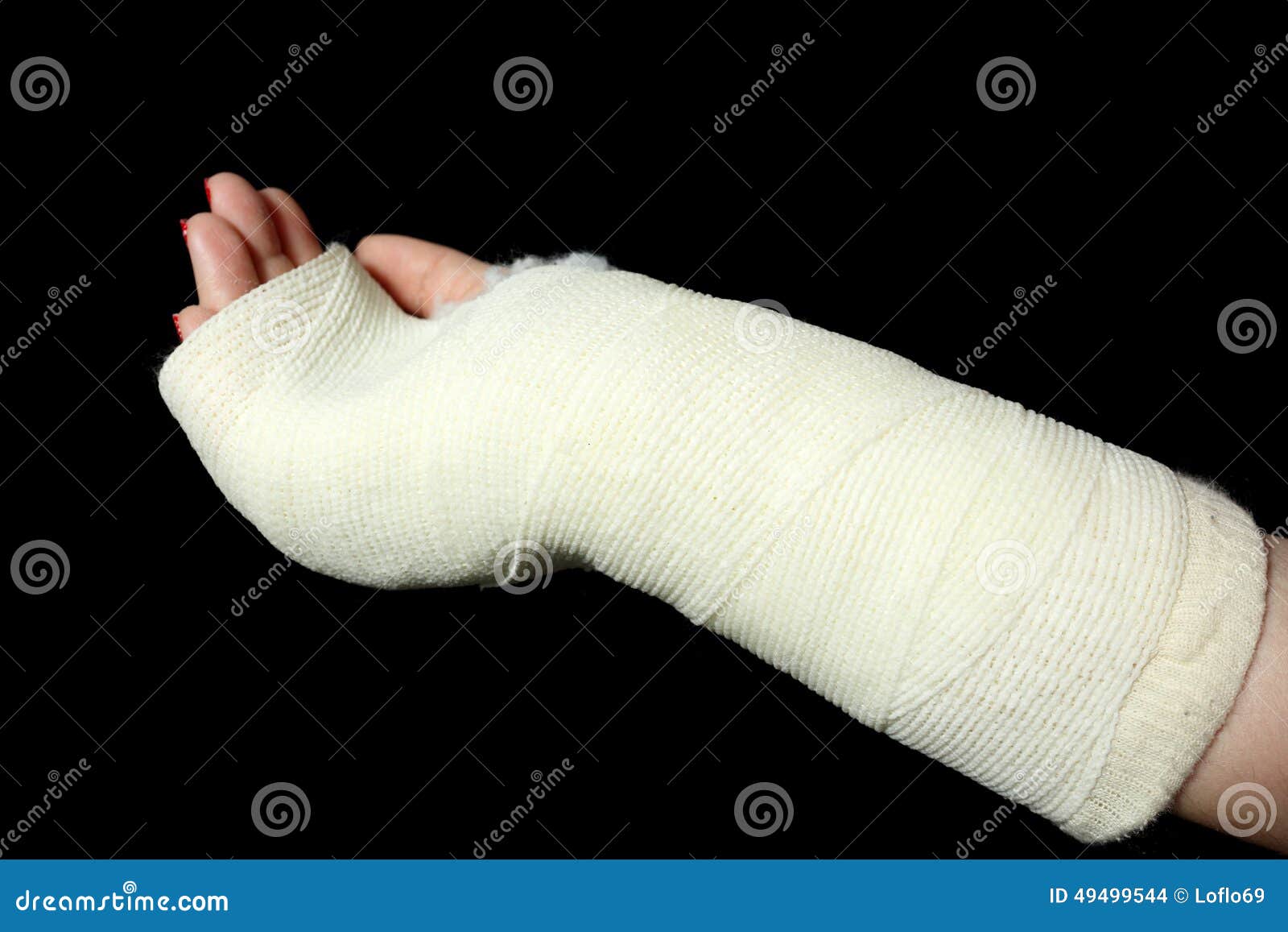 Orthopedic cast stock photo. Image of fracture, black 49499544