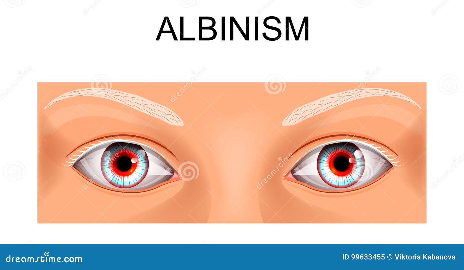 Os Olhos De Uma Pessoa Que Sofre Do Albinismo Ilustração do Vetor -  Ilustração de cegueira, corante: 99633455, image size:1600x932