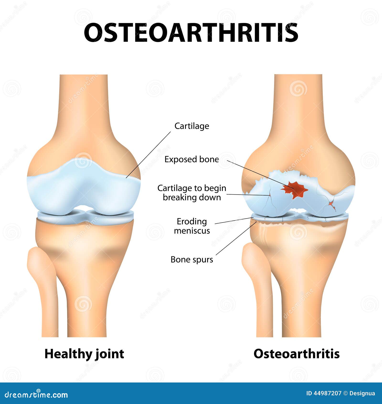 a fazett ízületek osteoarthritis