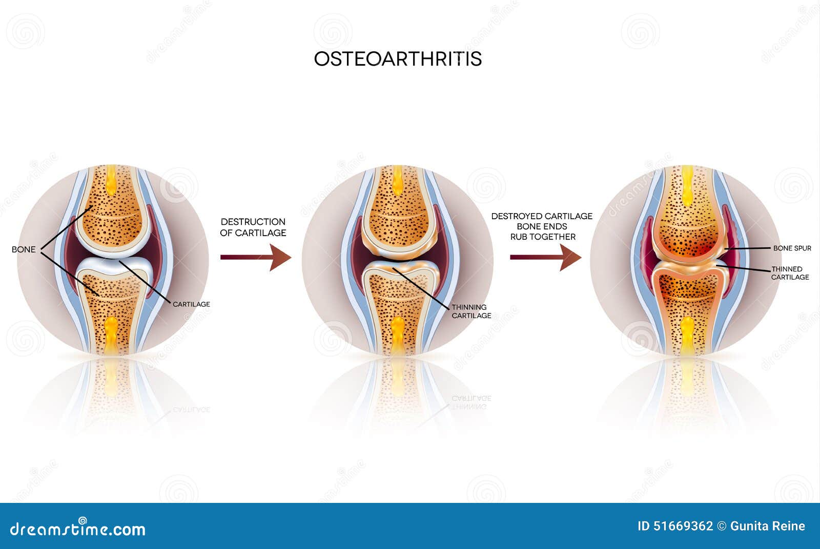 Osteoarthritis Detailed Illustration Stock Vector - Image: 51669362