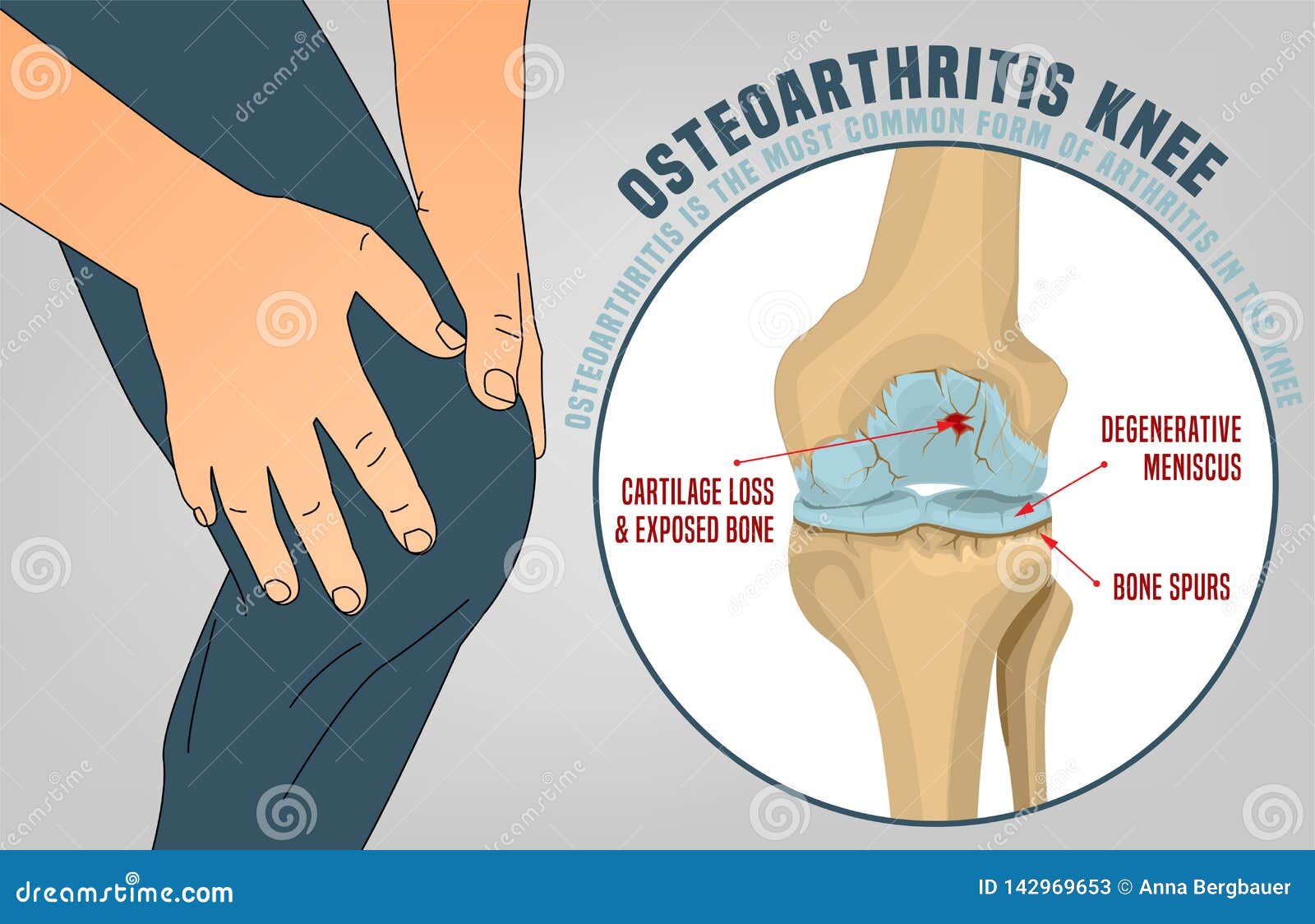 Osteoarthritis of the knee royalty free stock photography