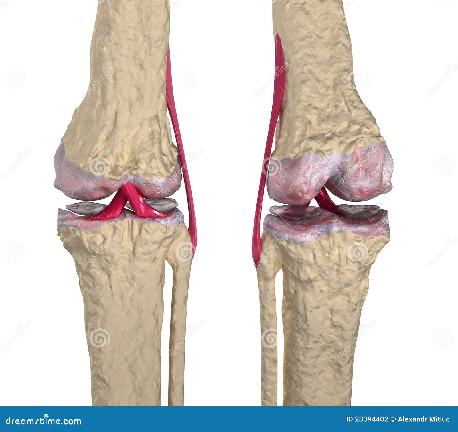 Osteoarthritis Knee Joint with Ligaments and Car Stock Illustration Illustration of knee