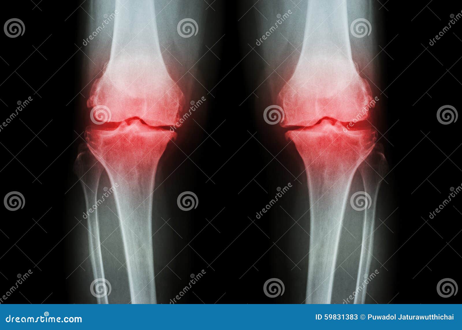osteoarthritis knee ( oa knee ). film x-ray both knee ( front view ) show narrow joint space ( joint cartilage loss ) , osteophyte