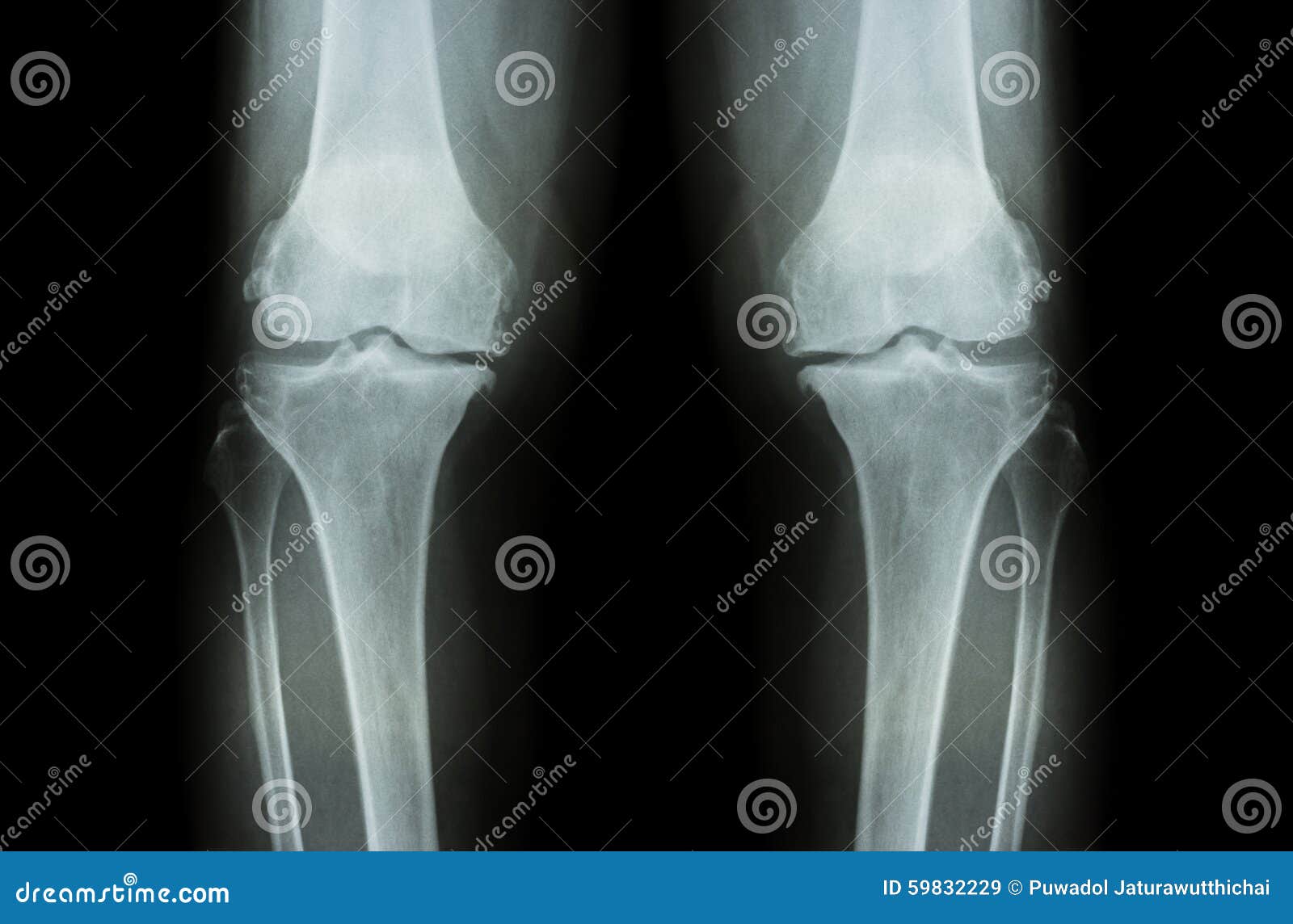 osteoarthritis knee ( oa knee ). film x-ray both knee ( front view ) show narrow joint space ( joint cartilage loss ) , osteophyte