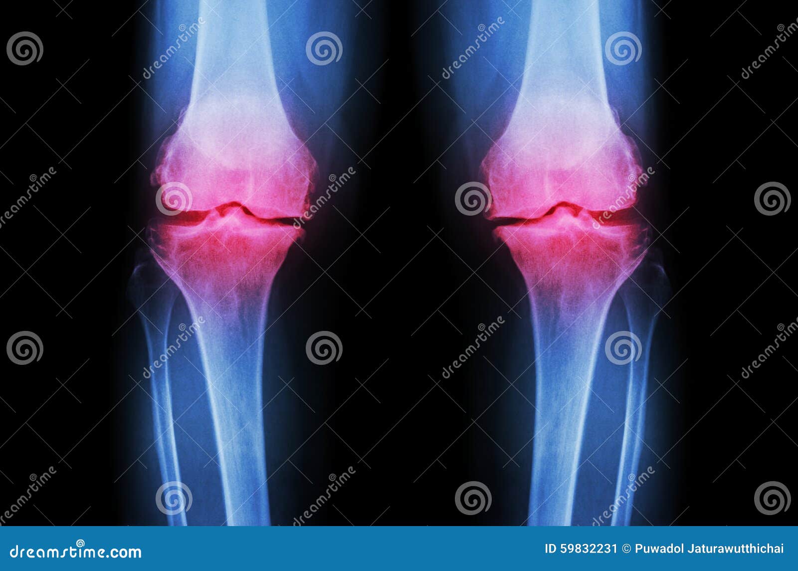 osteoarthritis knee ( oa knee ). film x-ray both knee ( front view ) show narrow joint space ( joint cartilage loss ) , osteophyte