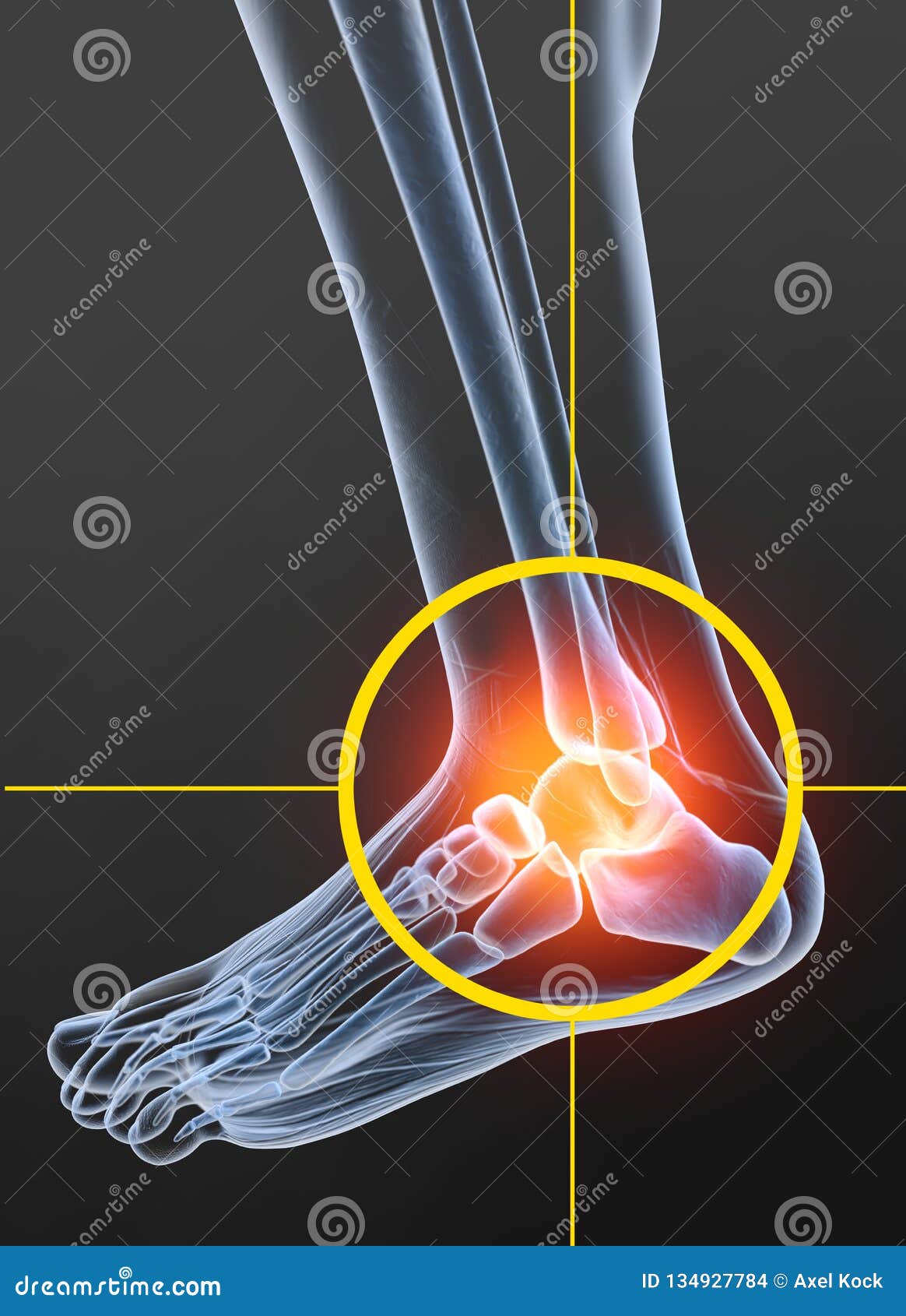 Osteoarthritis, Painful Ankle Joint, 3D Illustration Stock Photo
