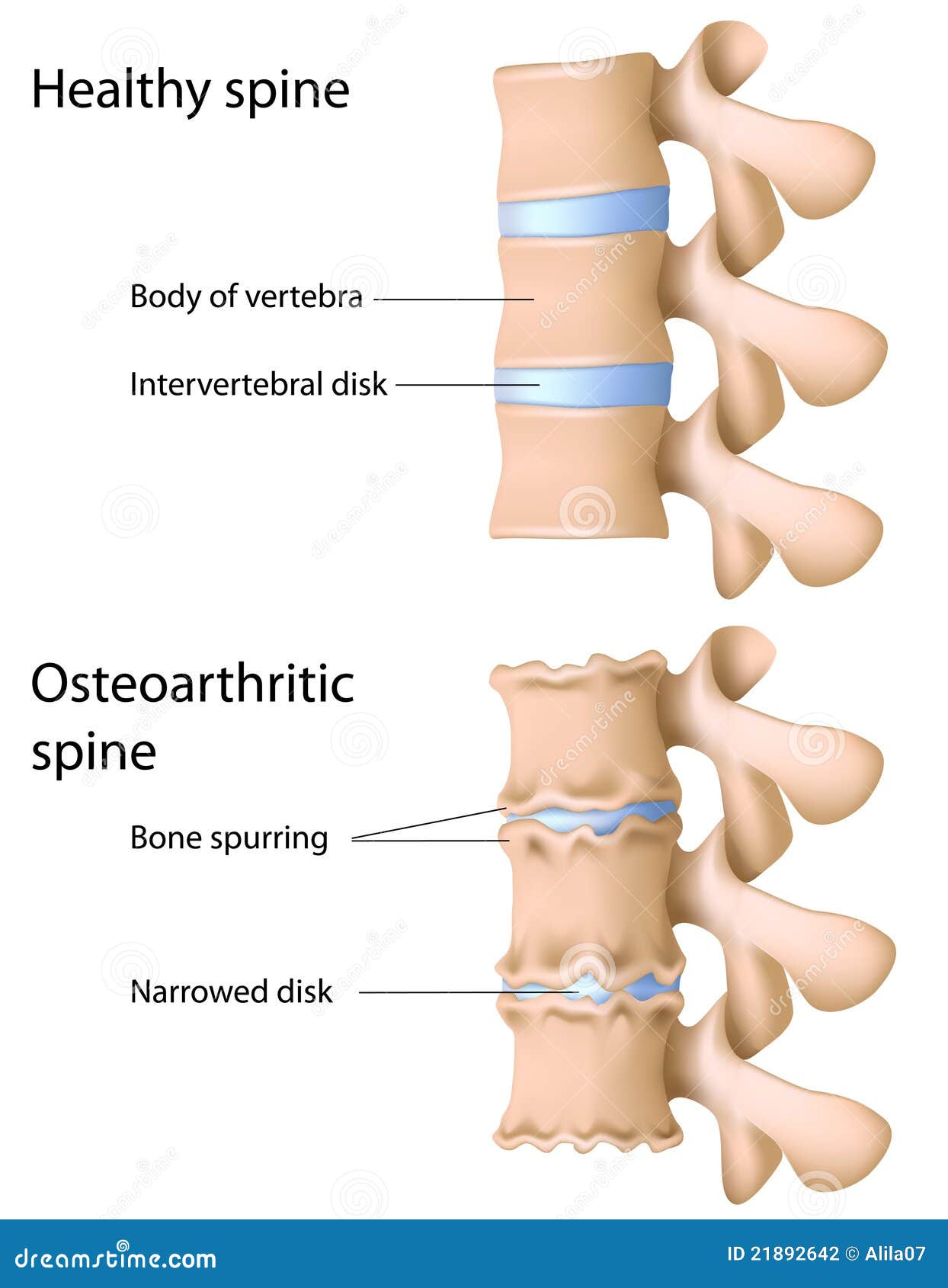 Osteoarthritis of the spine