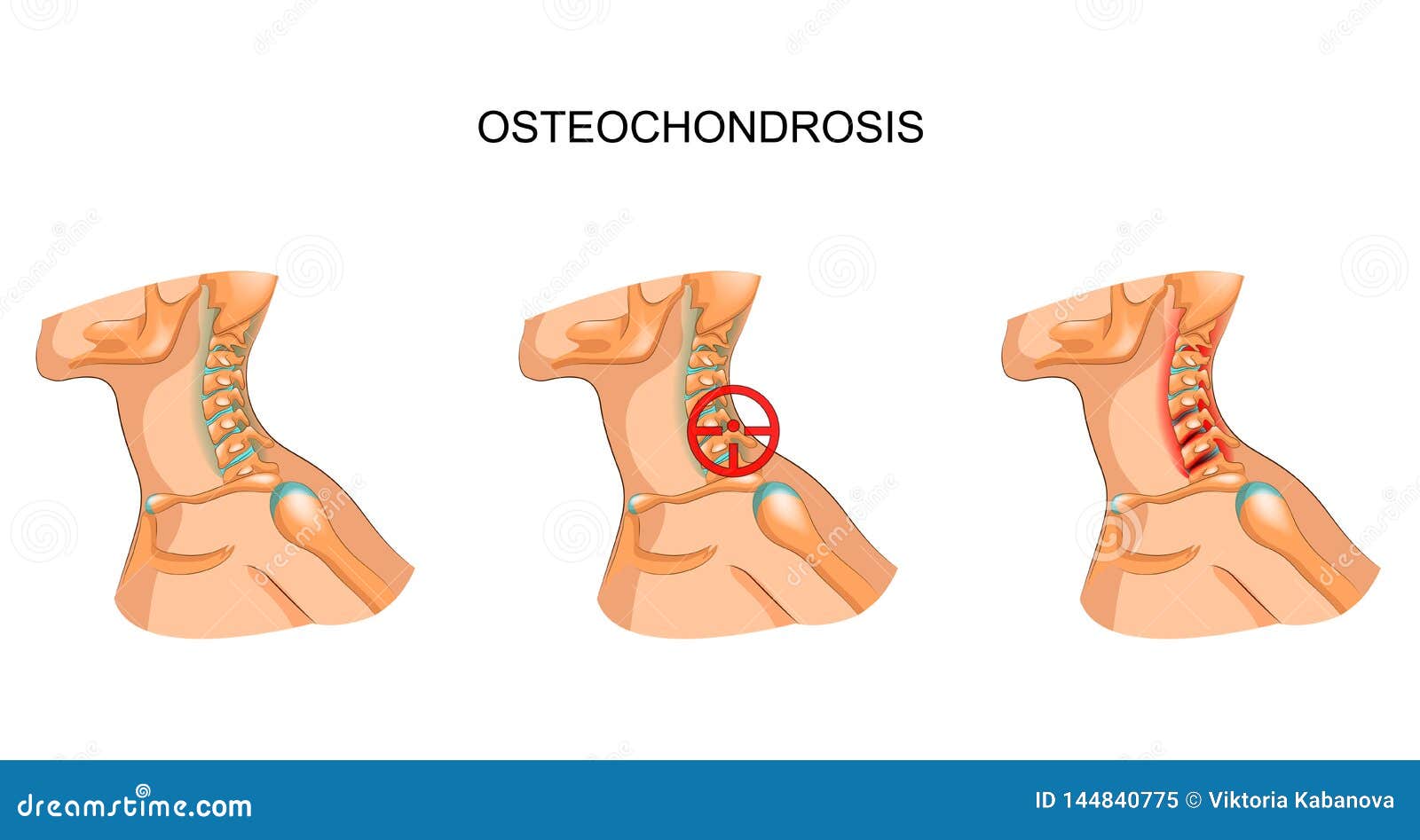 Osteochondrosis neck pain - Cervical osteochondrosis c5 6