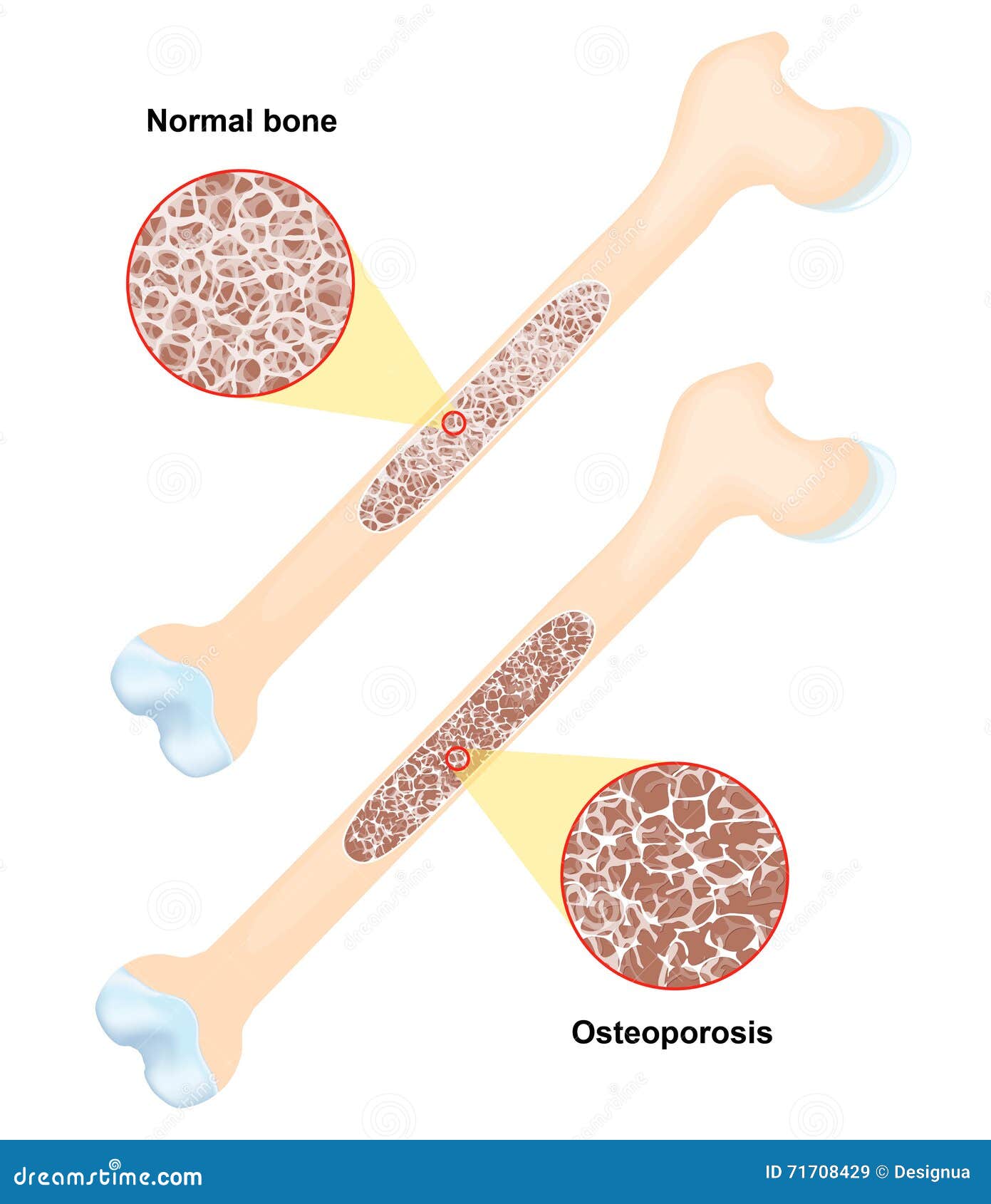 osteoporosis. disease of bones