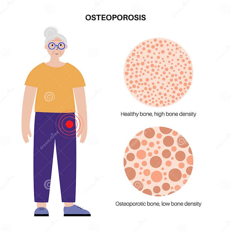 Osteoporosis medical poster stock illustration - illustration of