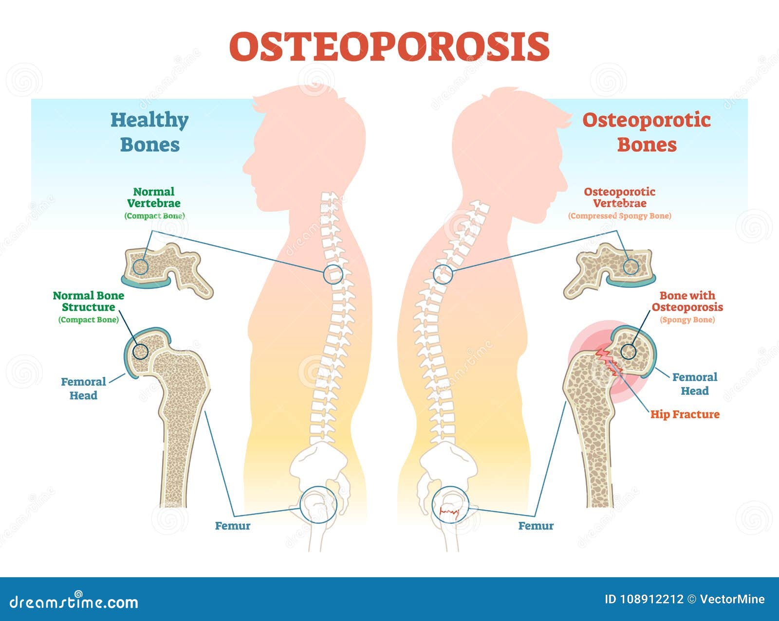 osteoporosis examples   diagram with bone density.