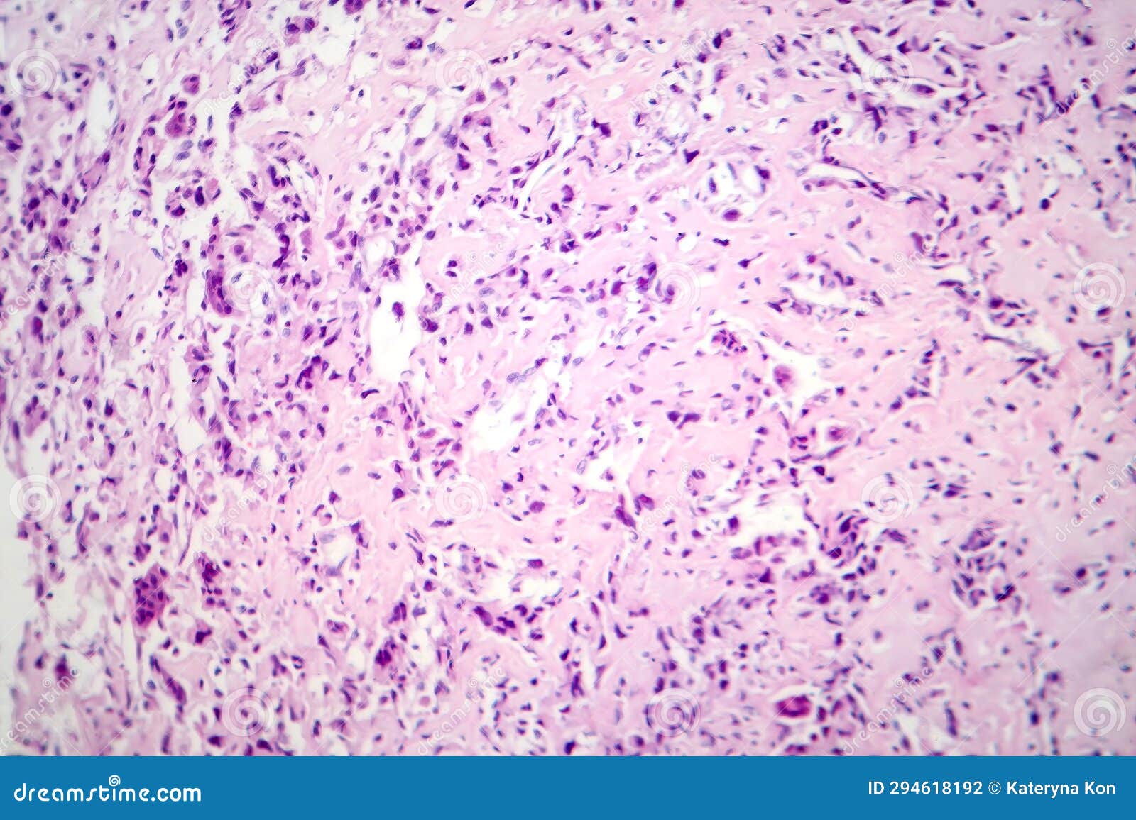 a Malignant Bone Tumor, Light Micrograph Under the