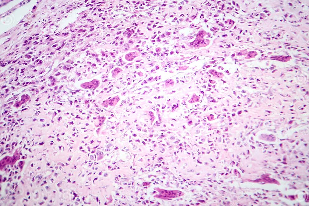 a Malignant Bone Tumor, Light Micrograph Under the