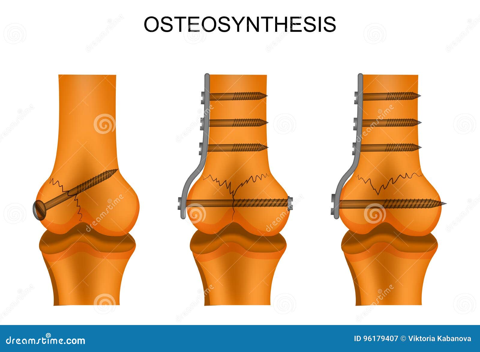 osteosynthesis of the femur