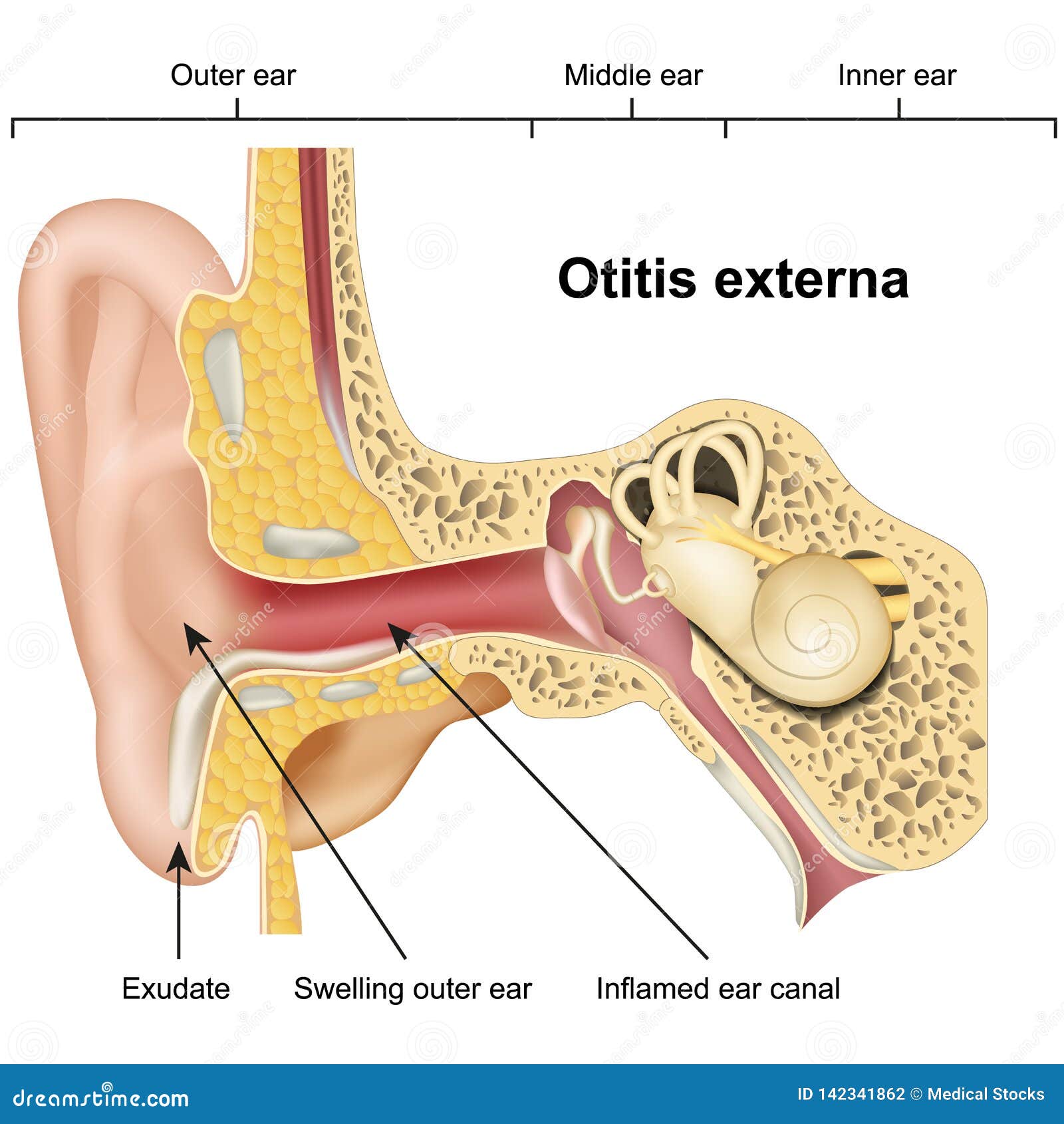 otitis externa ear disease 3d medical   on white background