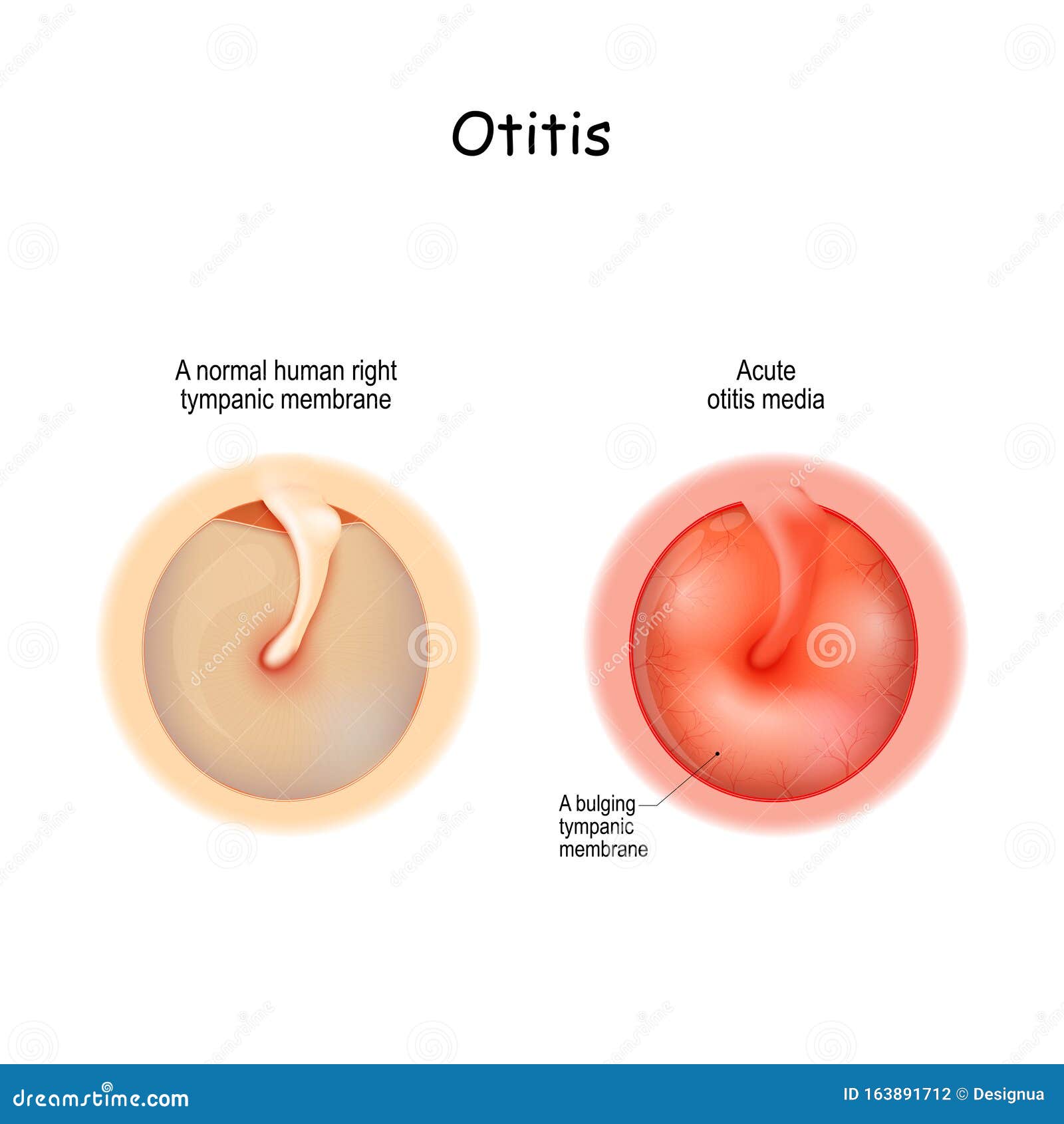 Acute Otitis Media Aom Wiscmed