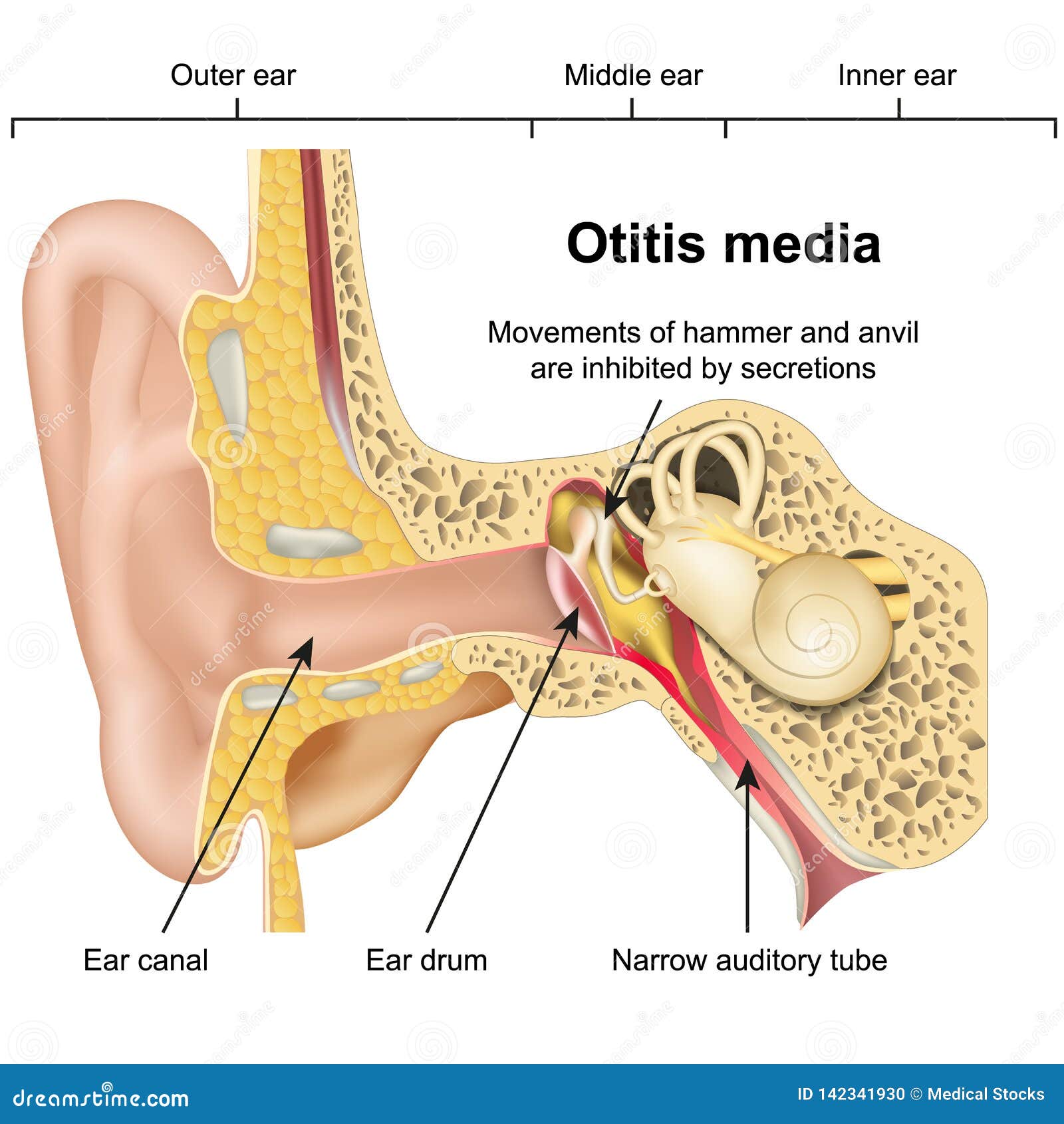 otitis media ear disease 3d medical   on white background