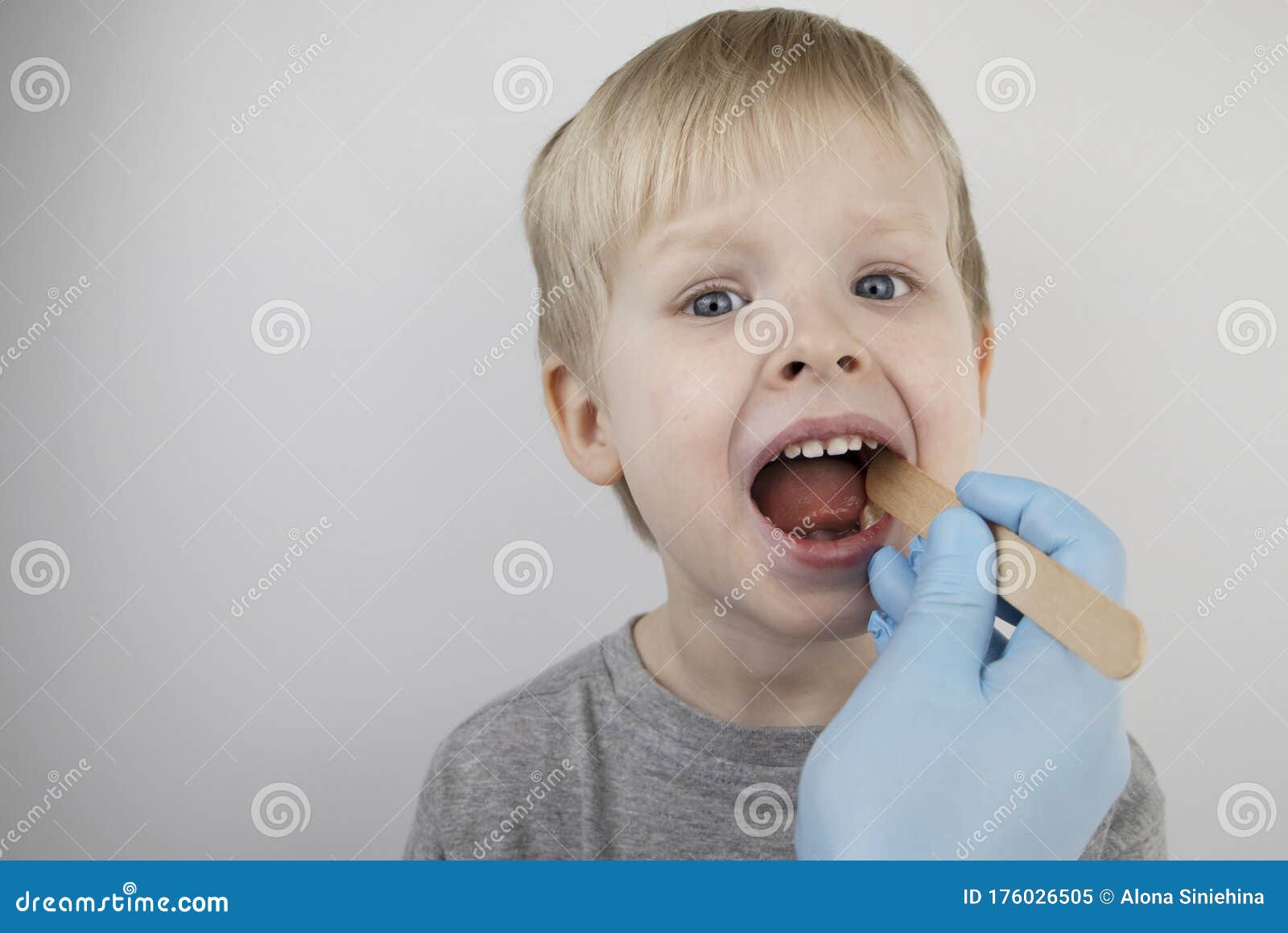 an otolaryngologist examines a child`s throat with a wooden spatula. a possible diagnosis is inflammation of the pharynx, tonsils