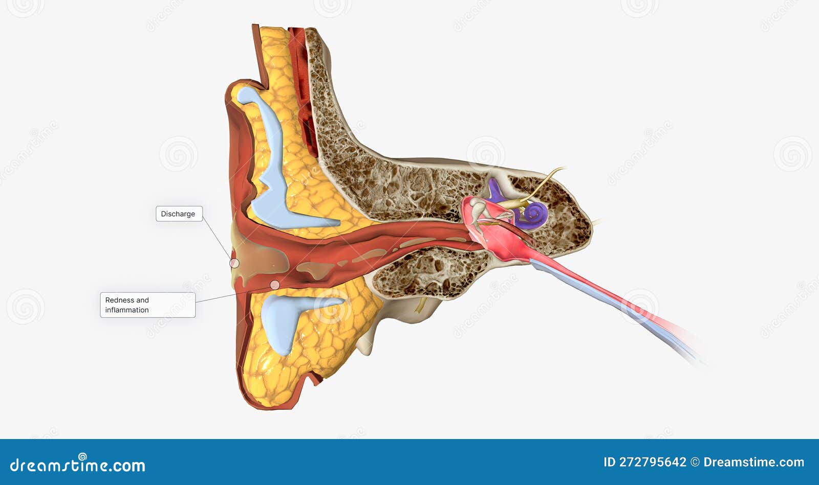 An Outer Ear Infection, Also Called Otitis Externa Stock Photography