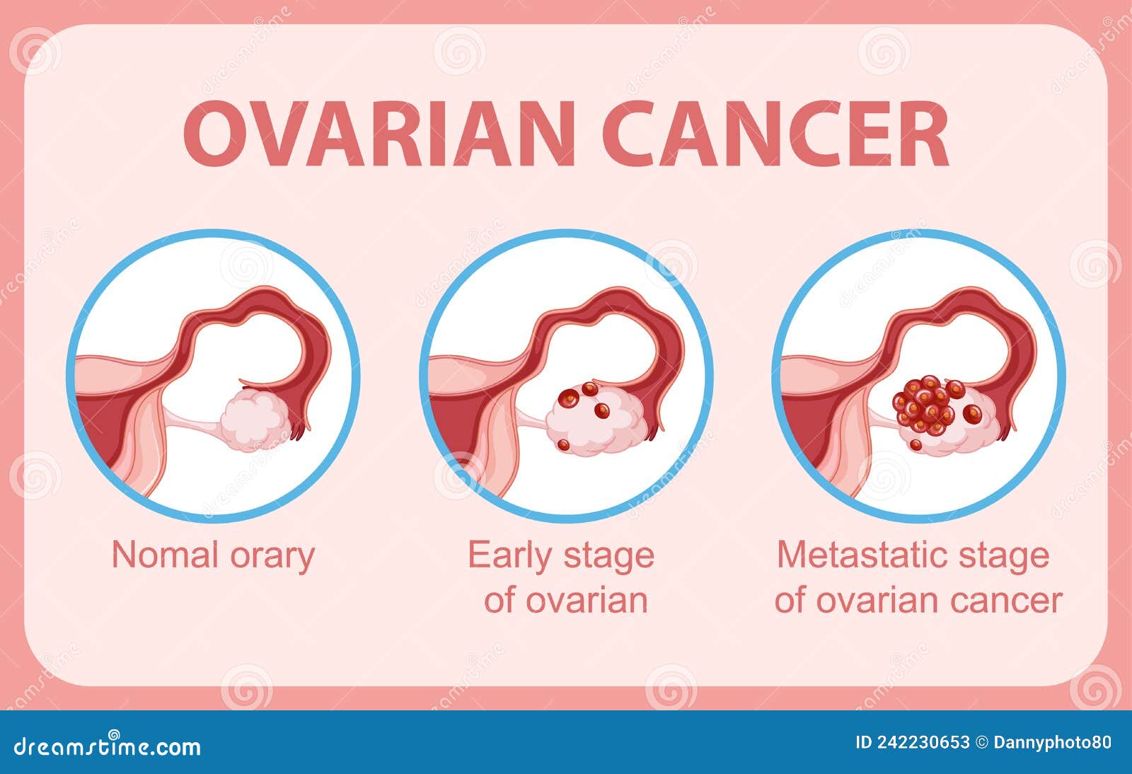 Ovarian Cancer Infographic Infographic Stock Vector - Illustration of ...