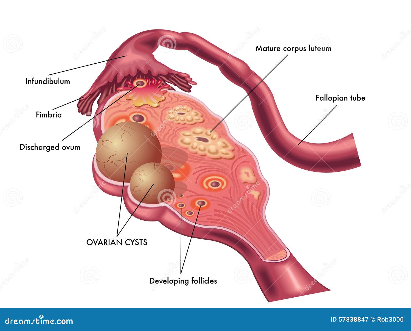 ovarian cyst