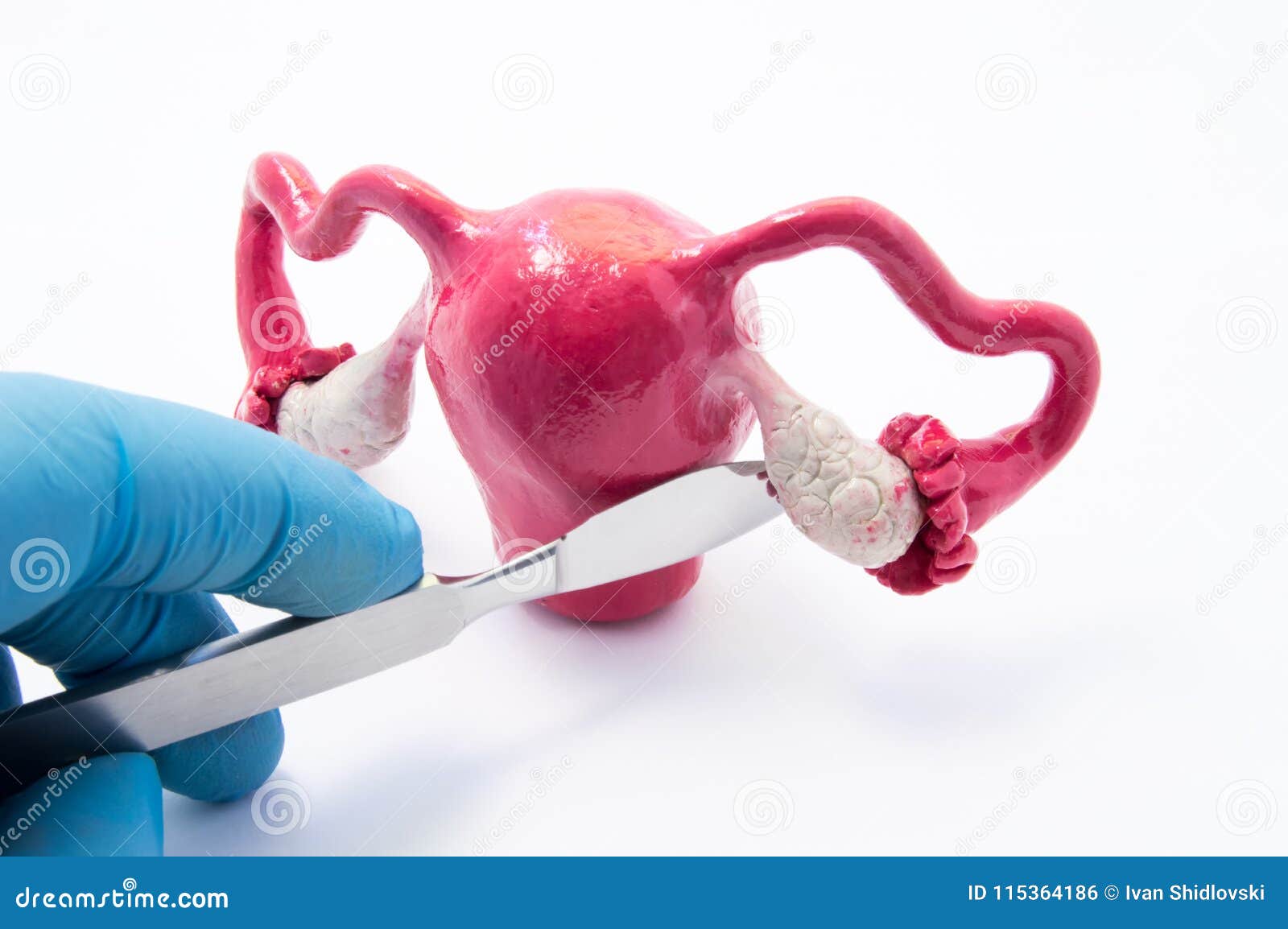 Surgery Of Genital Organs Of Uterus And Ovaries In Women. Model Of ...