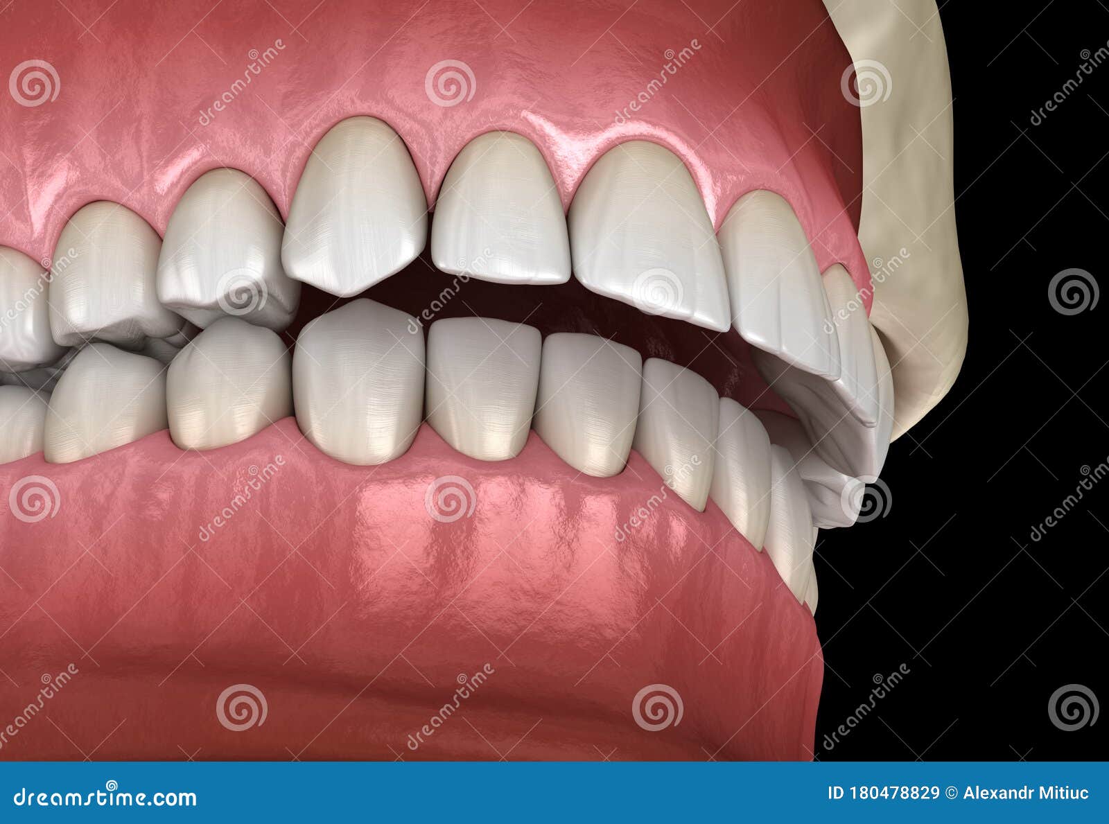 Overbite Dental Occlusion Malocclusion Of Teeth . Medically Accurate