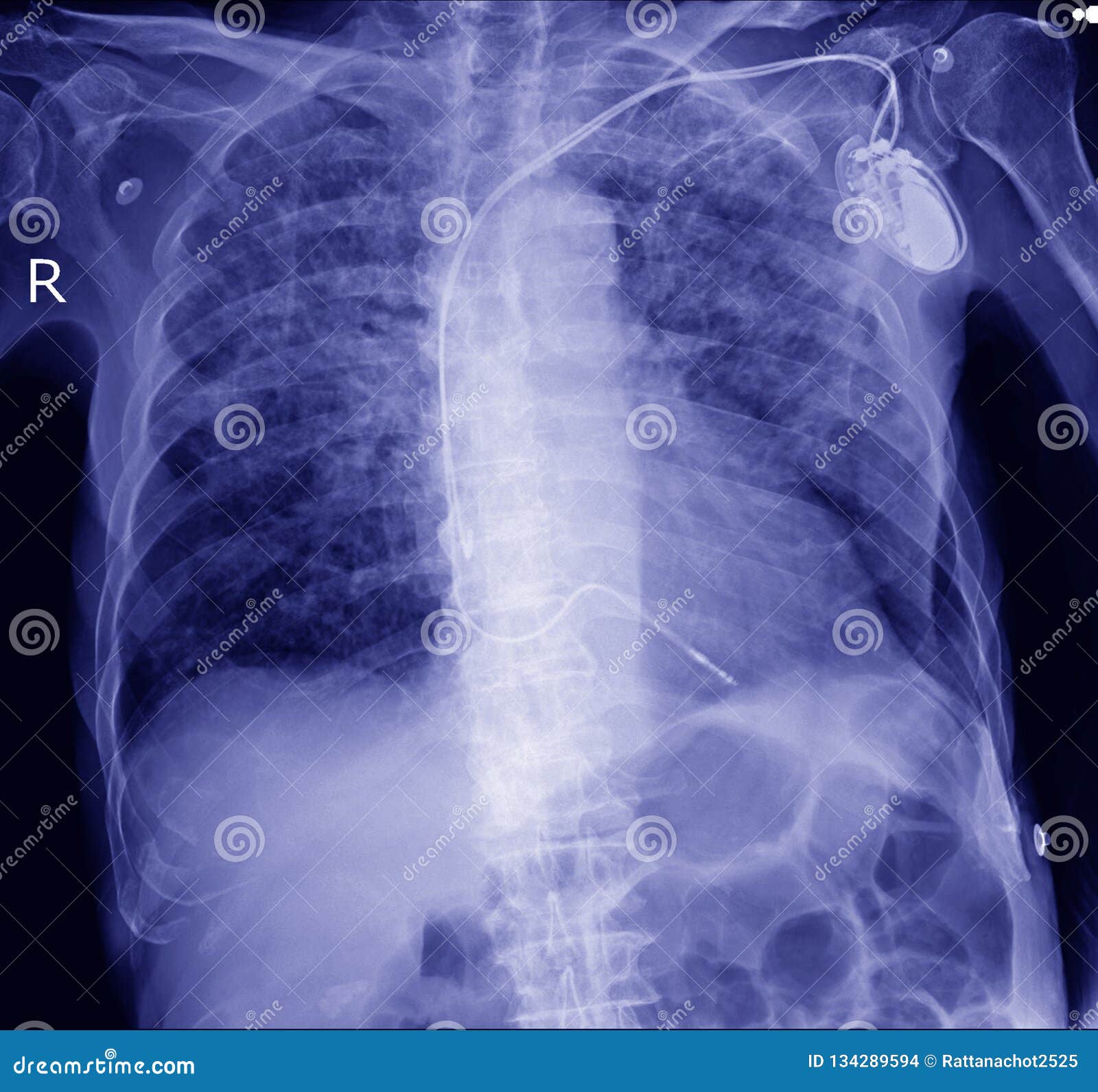 pacemaker in x-ray image in cardiac catheterization laboratory