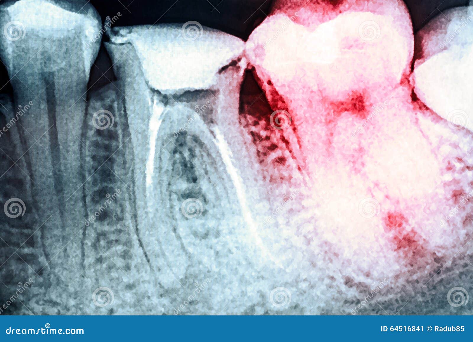 Pain of Tooth Decay on XRay Stock Image Image of endodontics, decay