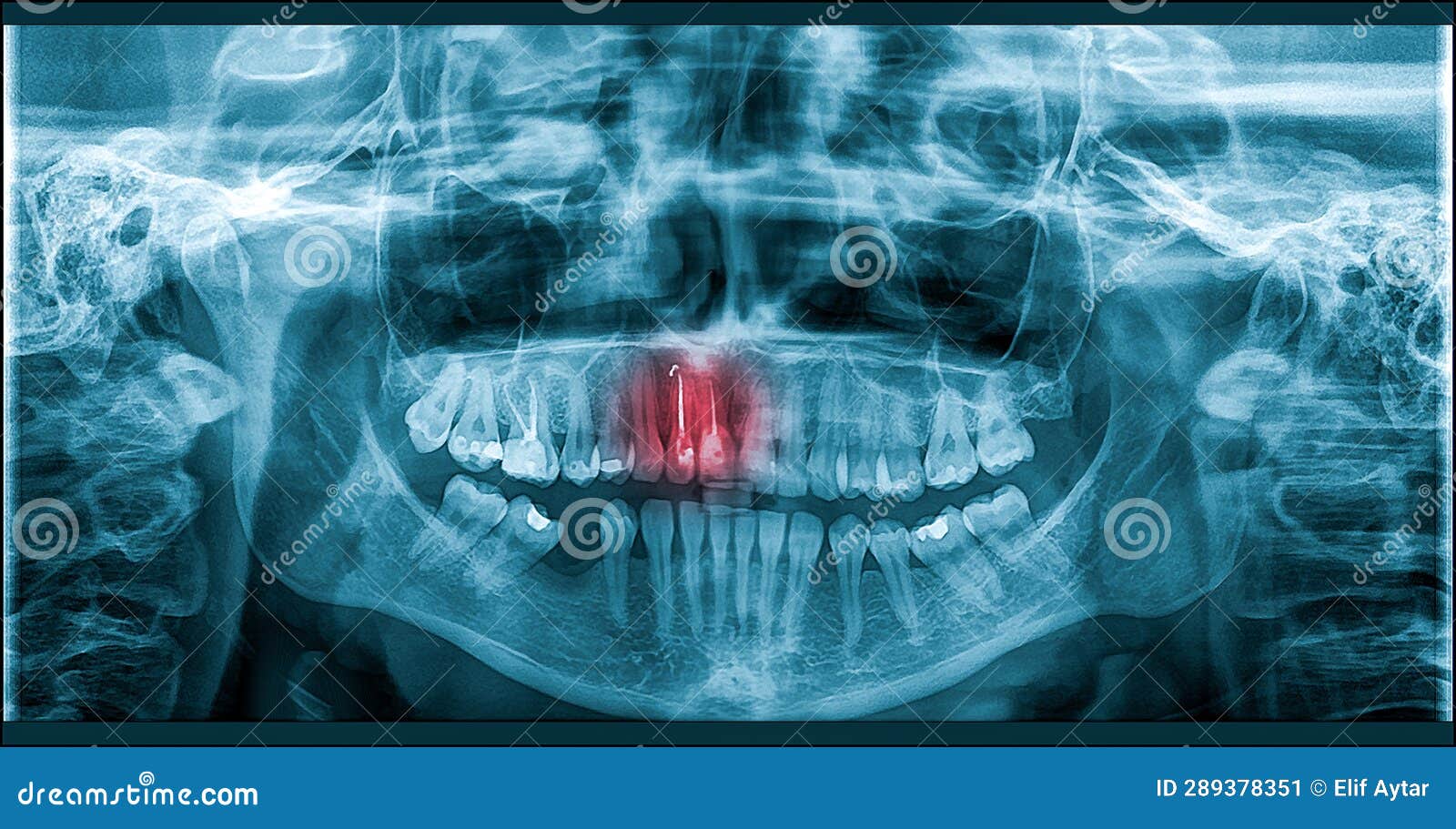 Pain of Tooth Decay on Teeth XRay Stock Image Image of beam