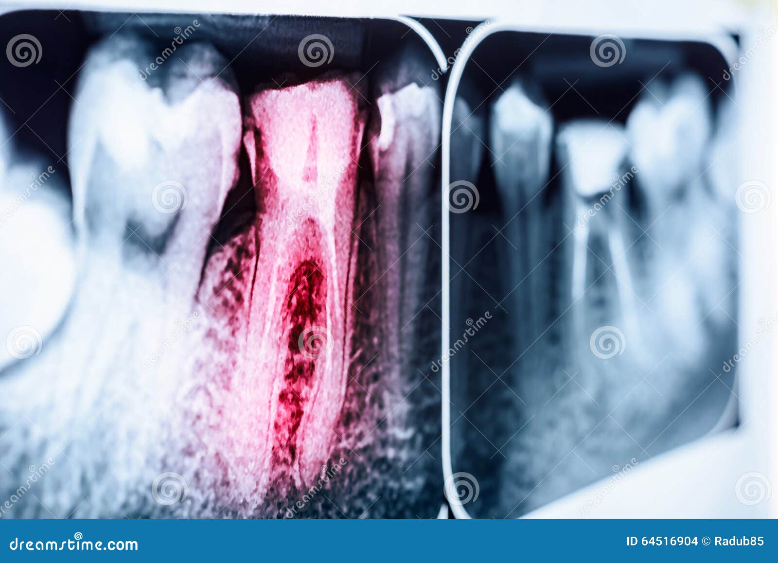 pain of tooth decay on x-ray