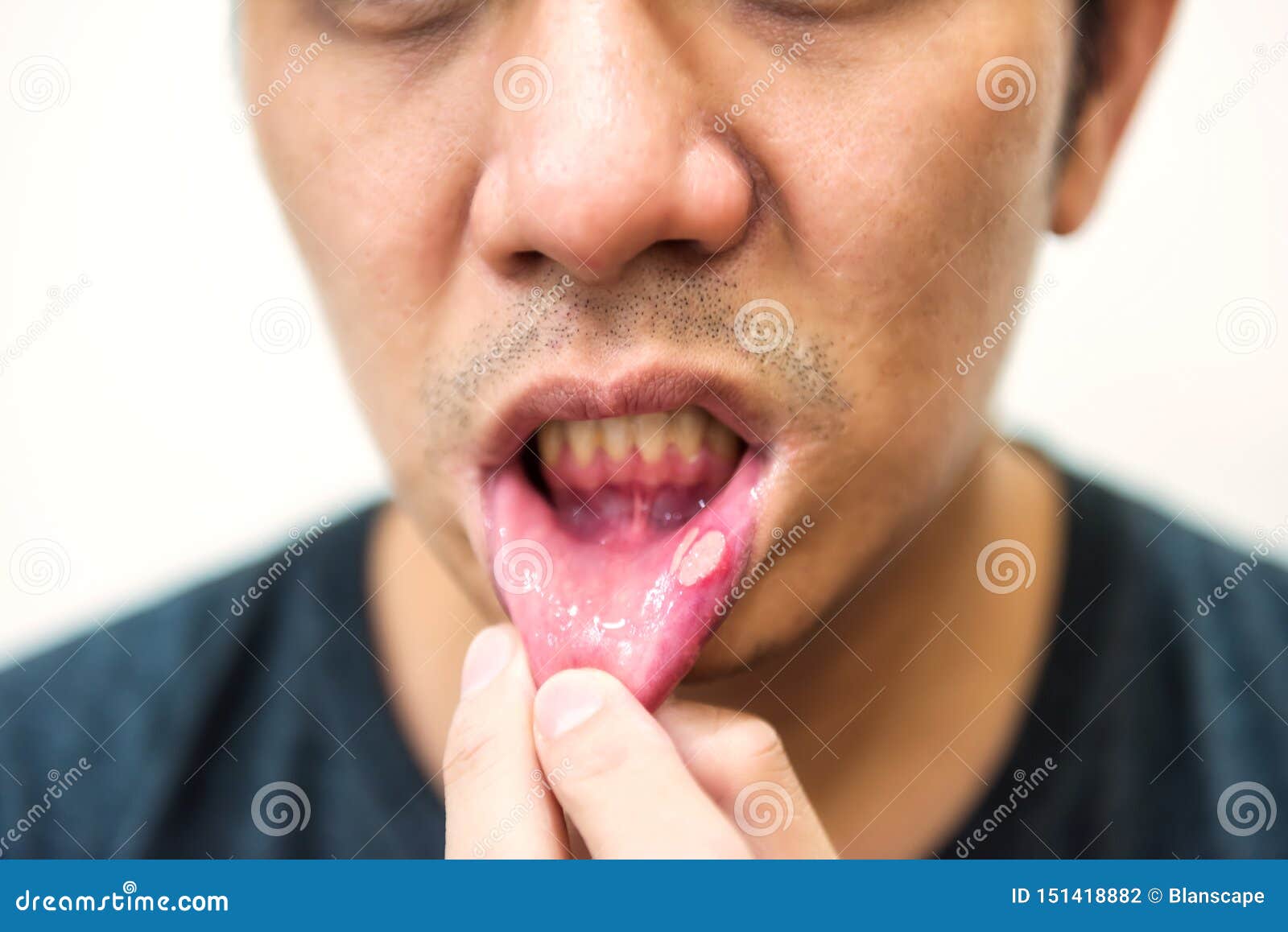 pained aphtha ulcer mouth from accident