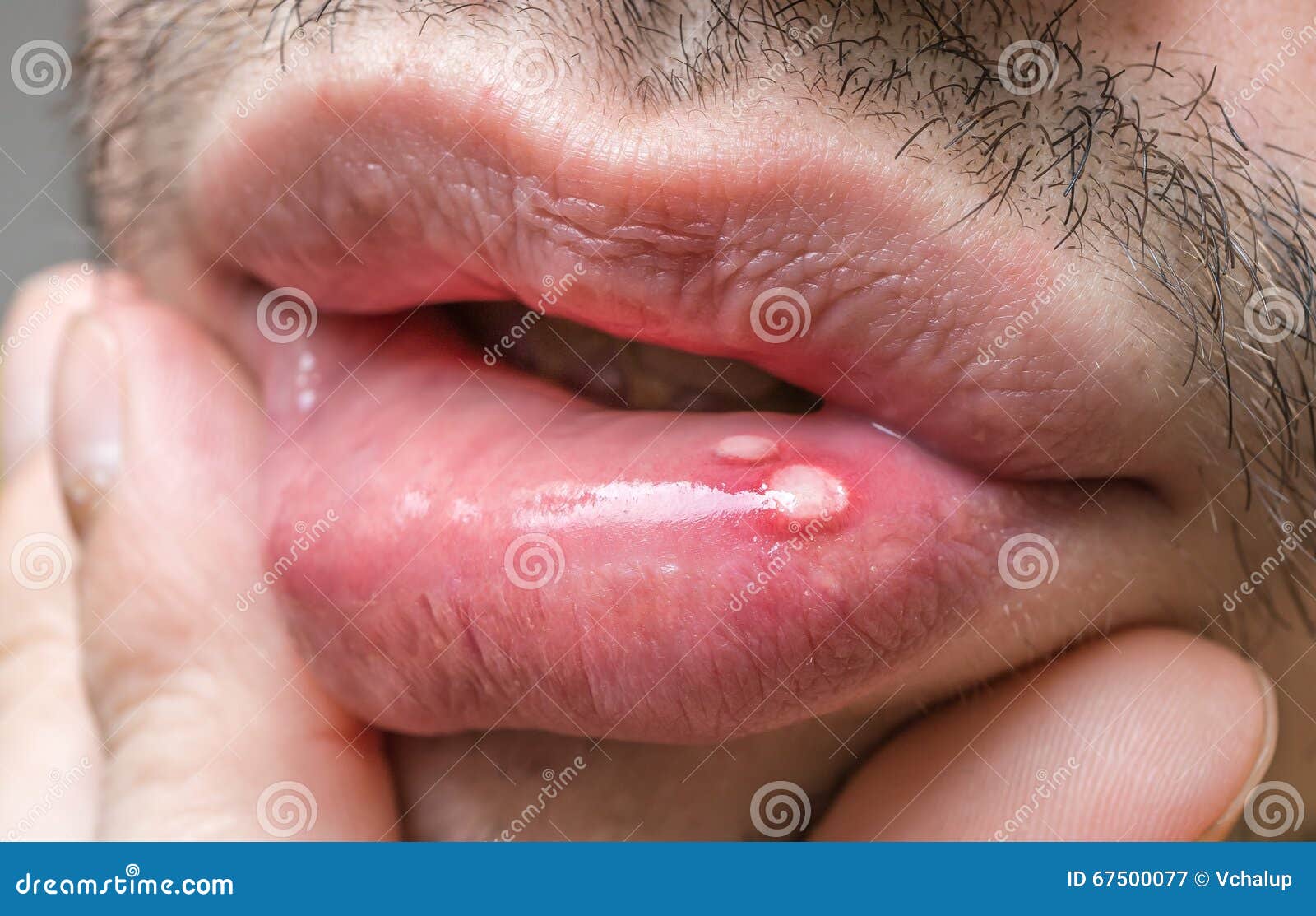 painful aphtha ulcer on man's mouth