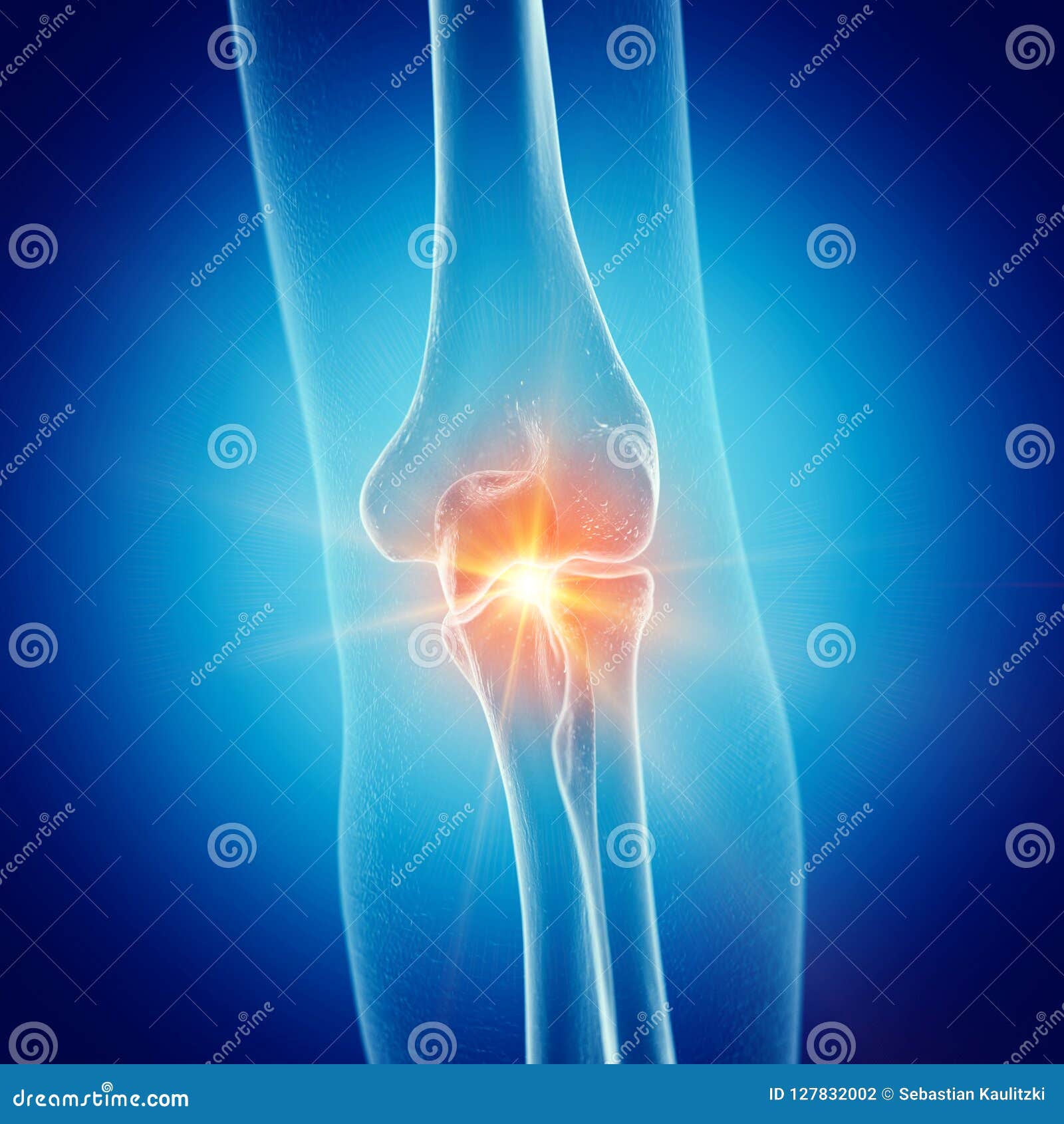 A painful elbow joint stock illustration. Illustration of graphic