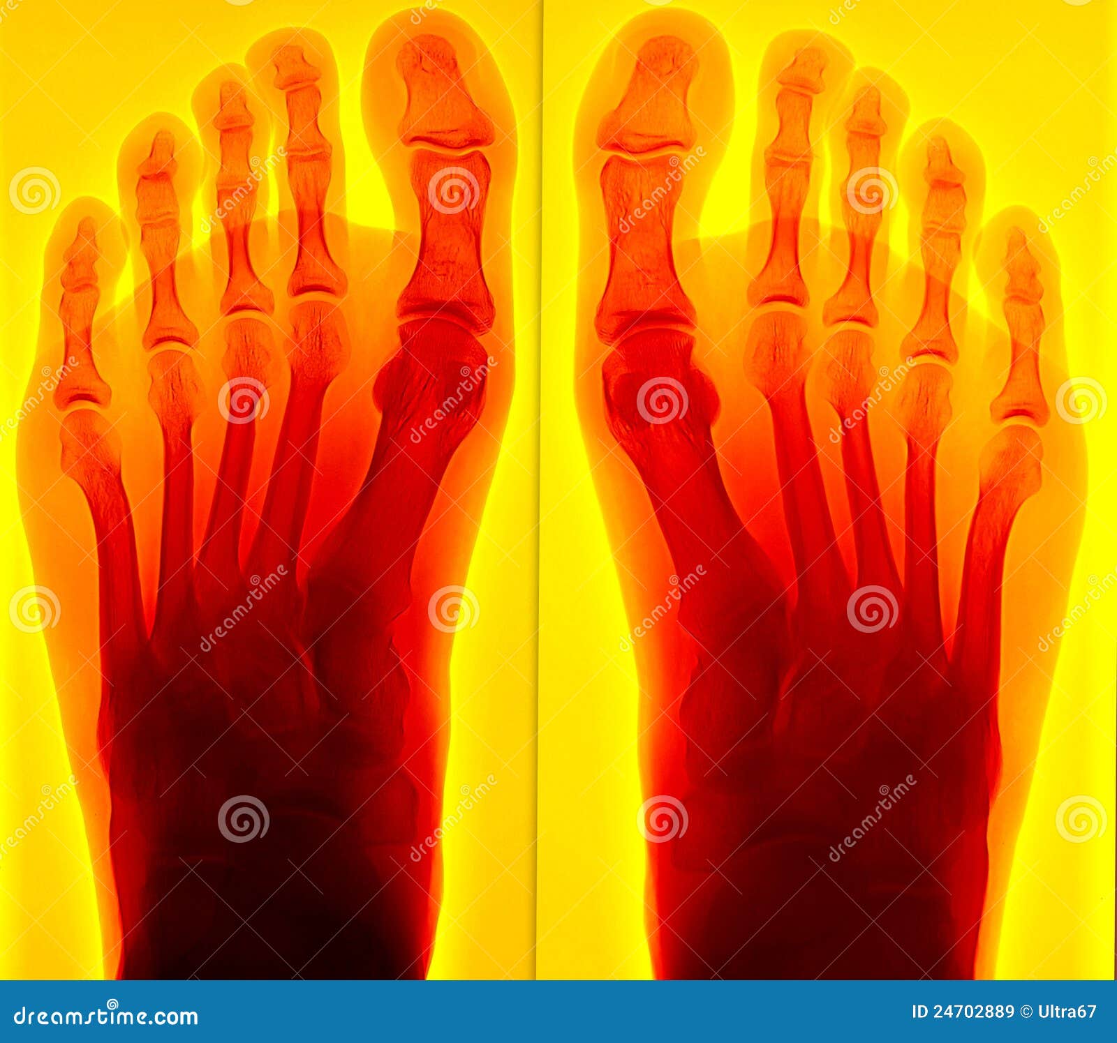 painful foot xray