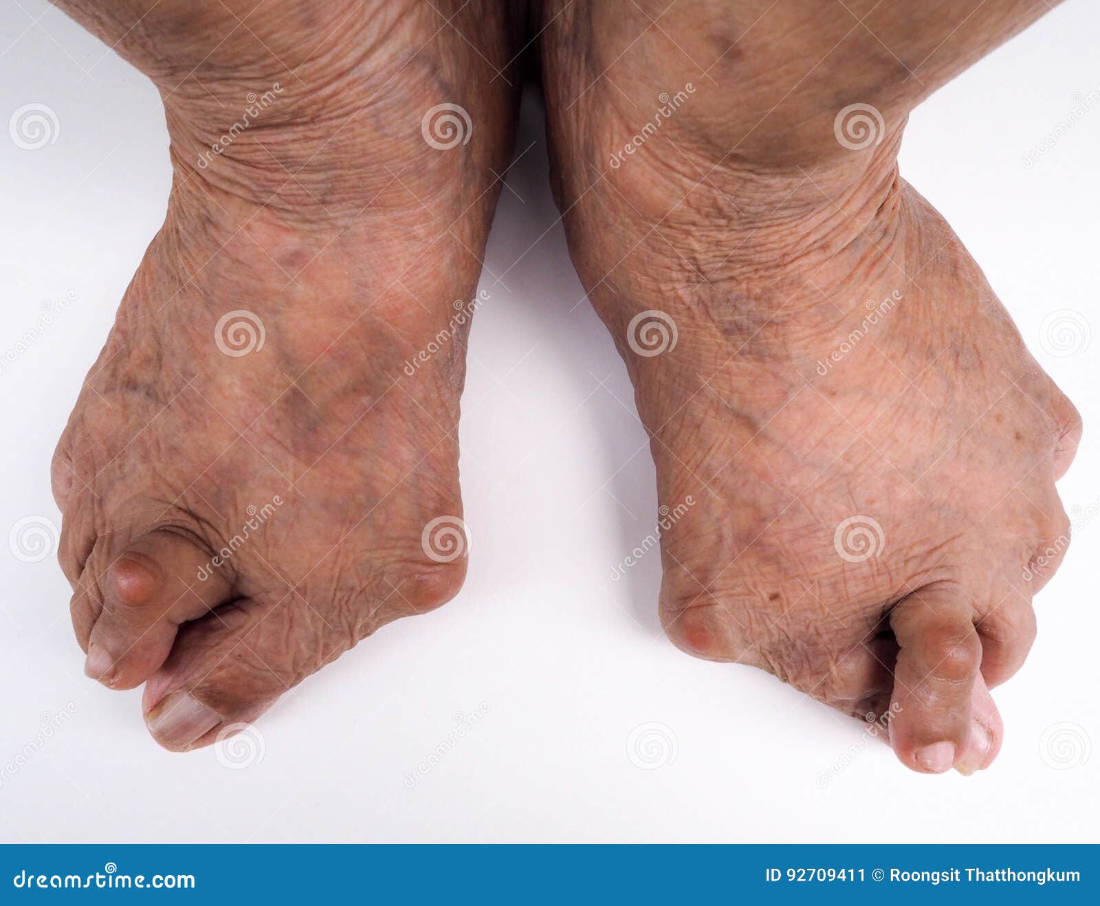 https://thumbs.dreamstime.com/z/painful-gout-inflammation-foot-big-toe-joint-white-background-old-man-finger-as-result-deformities-92709411.jpg