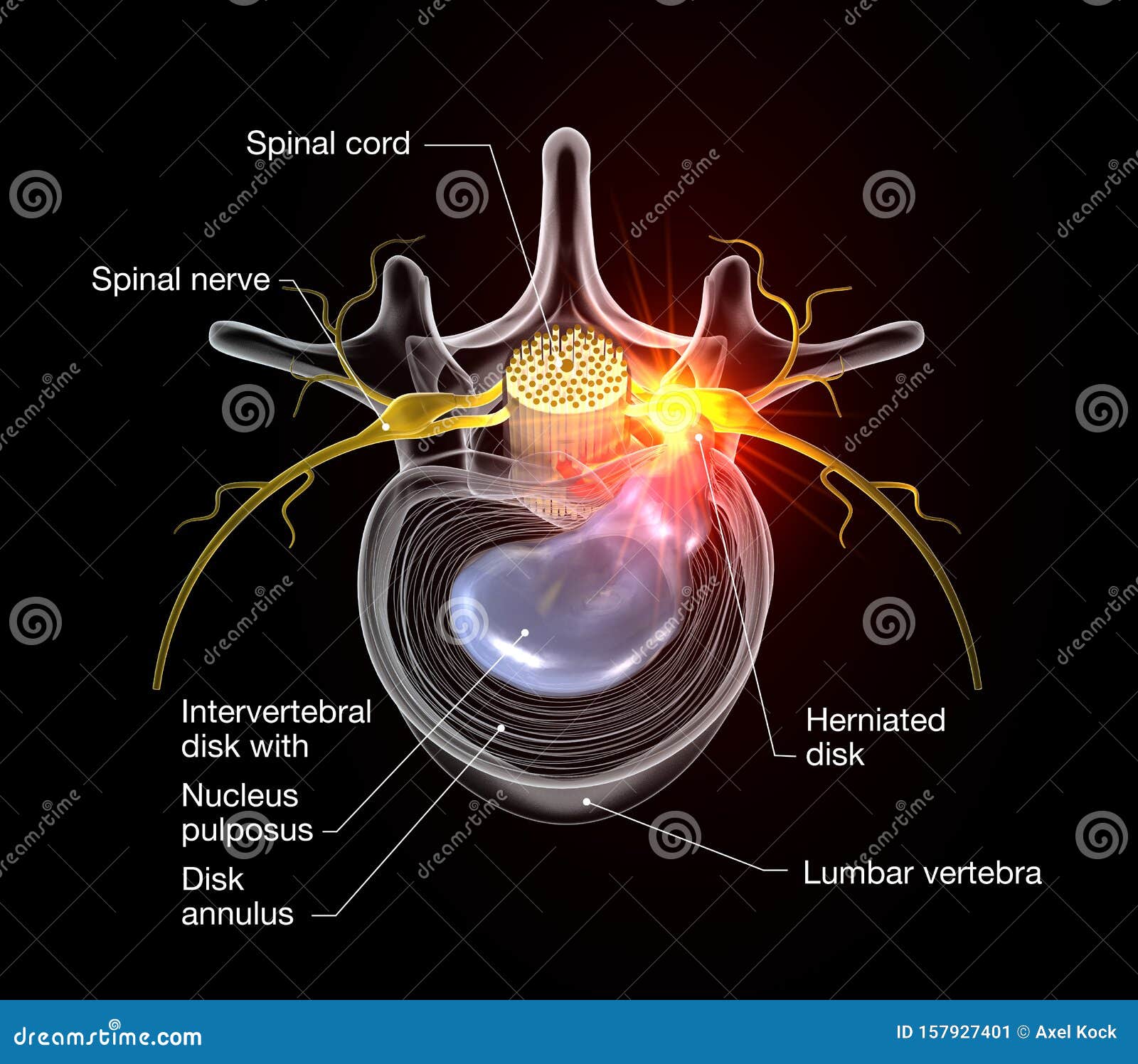 Painful Herniated Disk, Medically 3D Illustration on Black Background