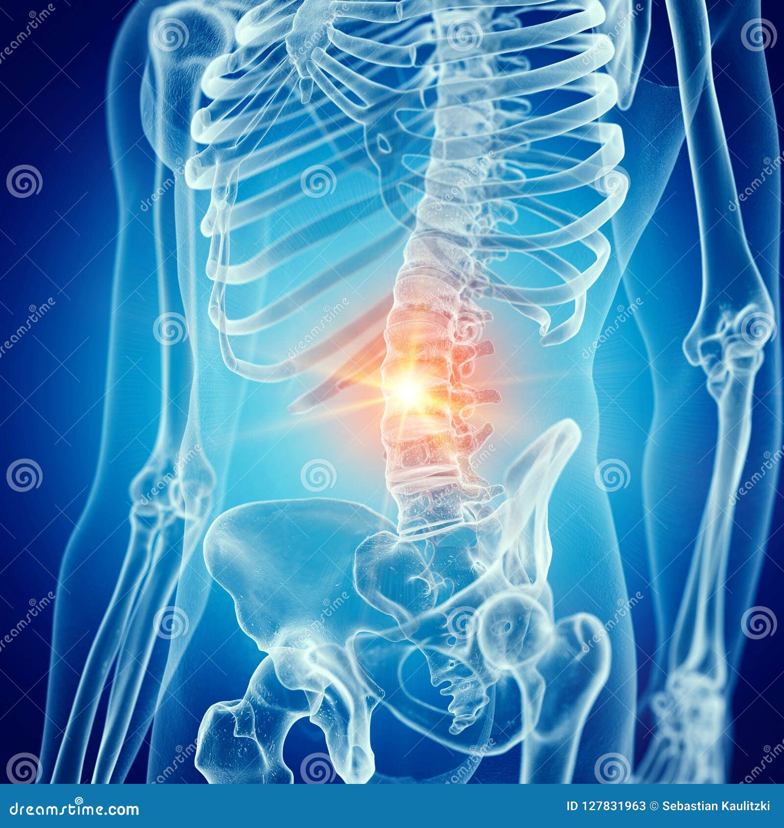 A painful lower back stock illustration. Illustration of curvature