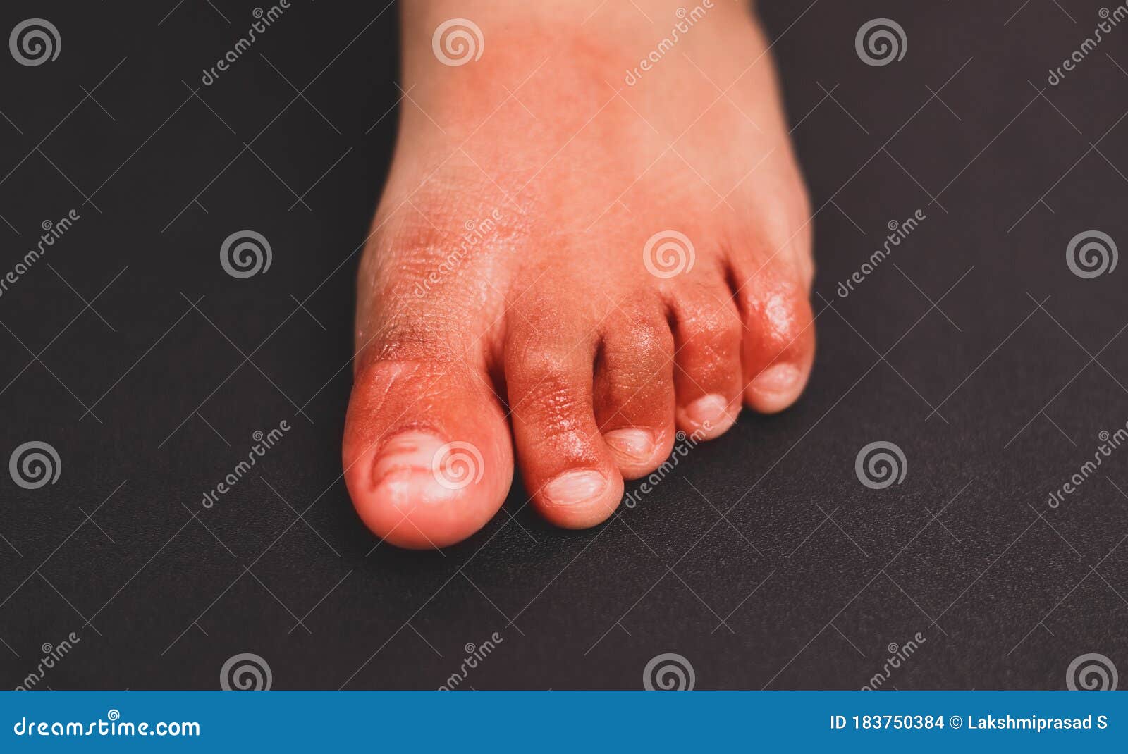 painful red inflammation on toe called covid toe lesions strange sign of new coronavirus symptoms or infections