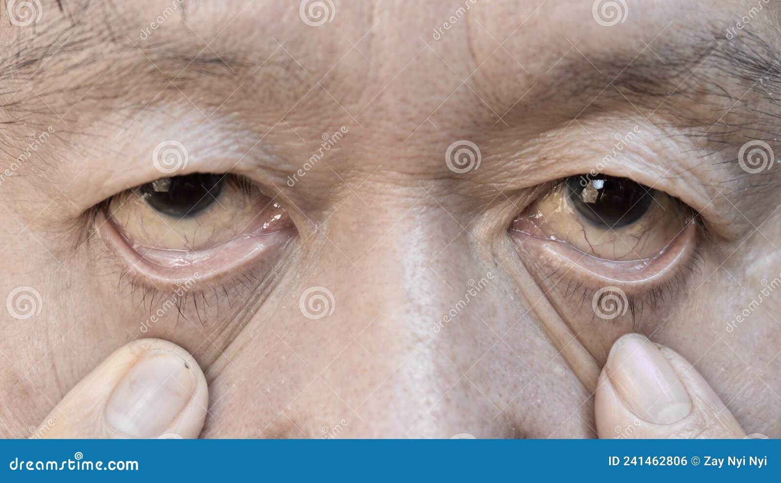 pale skin of asian man. sign of anemia. pallor at eyelid