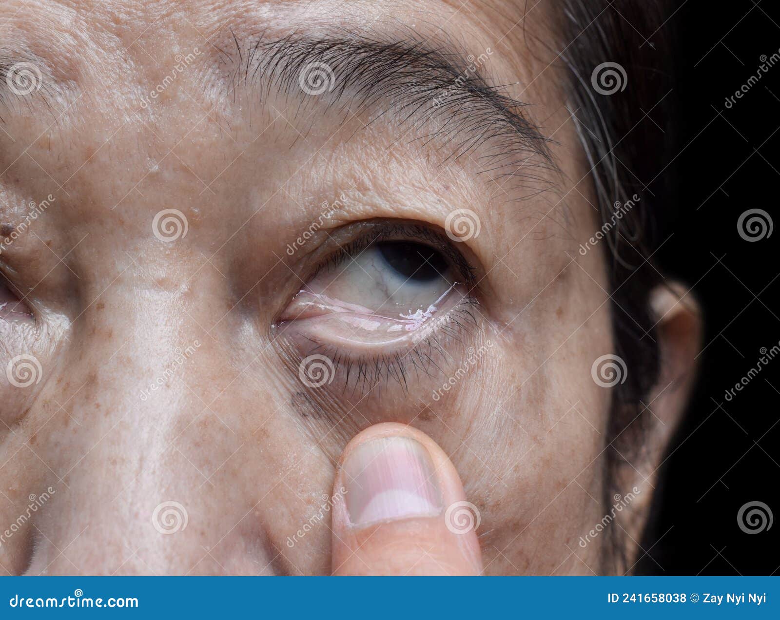 pale skin of asian woman. sign of anemia. pallor at eyelid