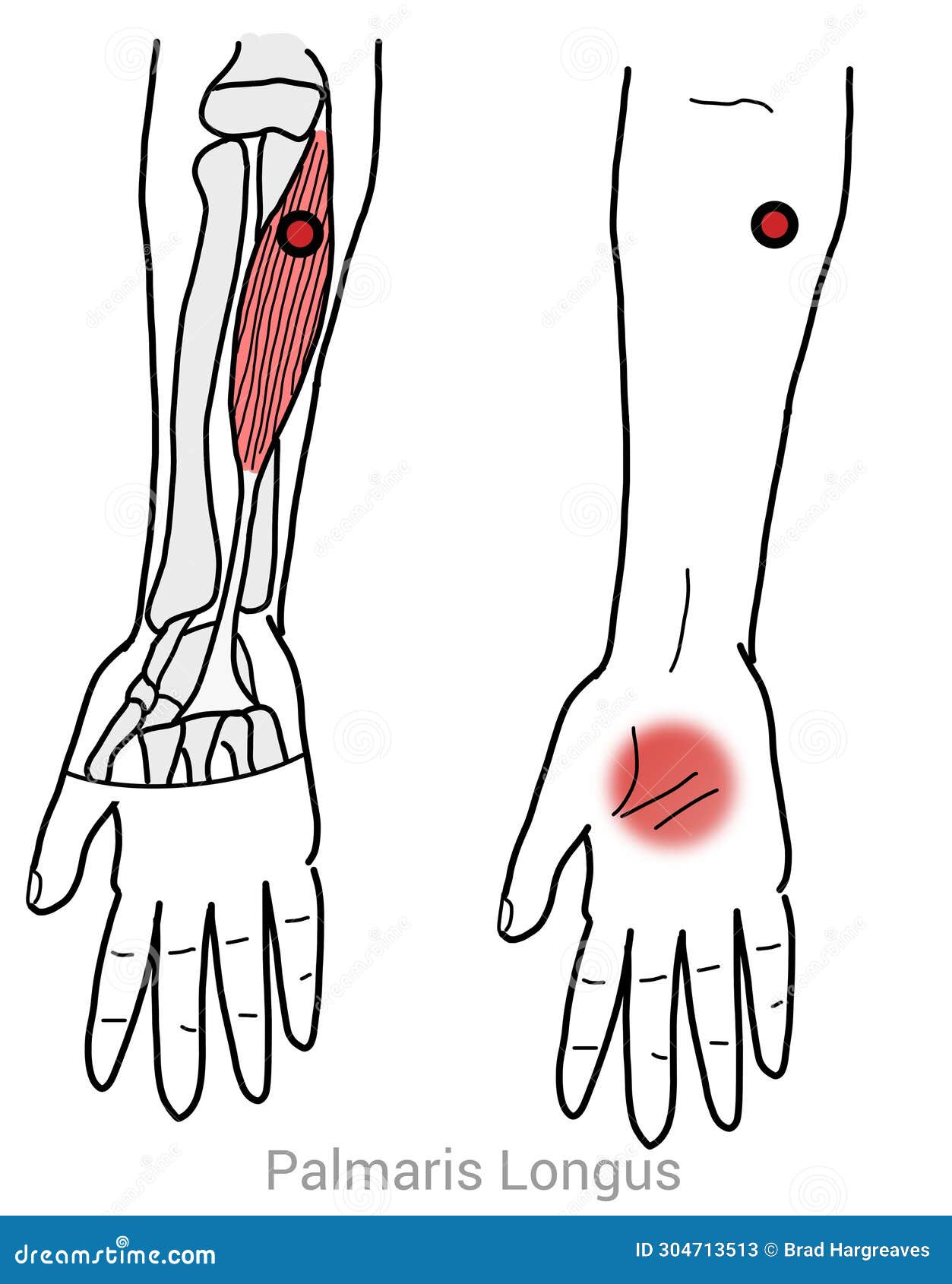 palmaris longus myofascial trigger points and hand palm pain