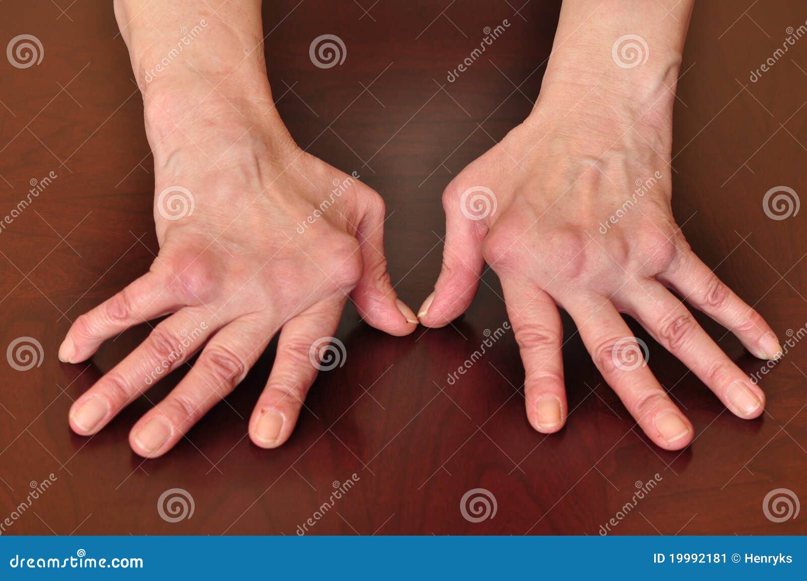 остеопороз пальцев рук симптомы фото