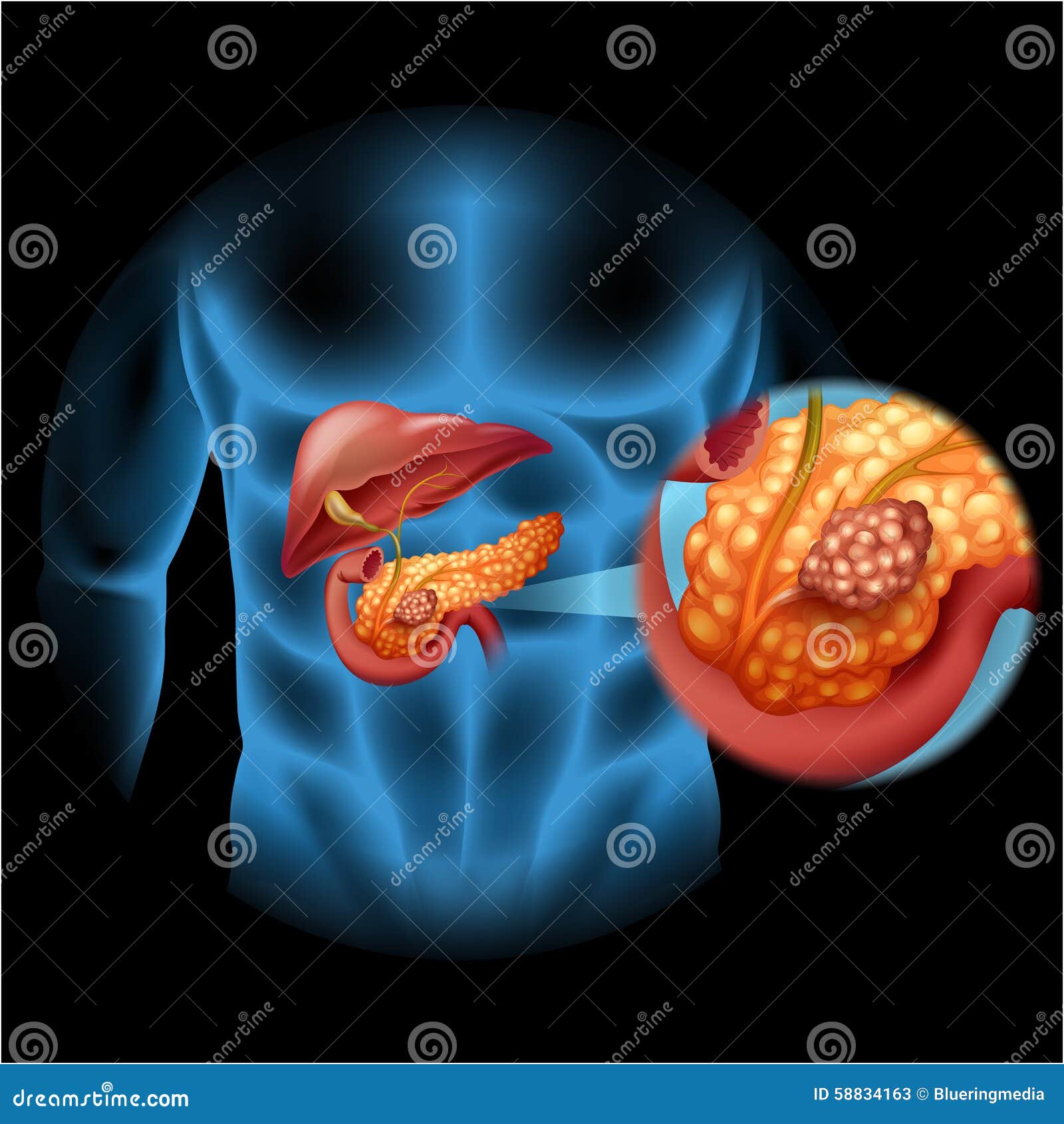 Pancreas Cancer Diagram In Human Body Stock Vector